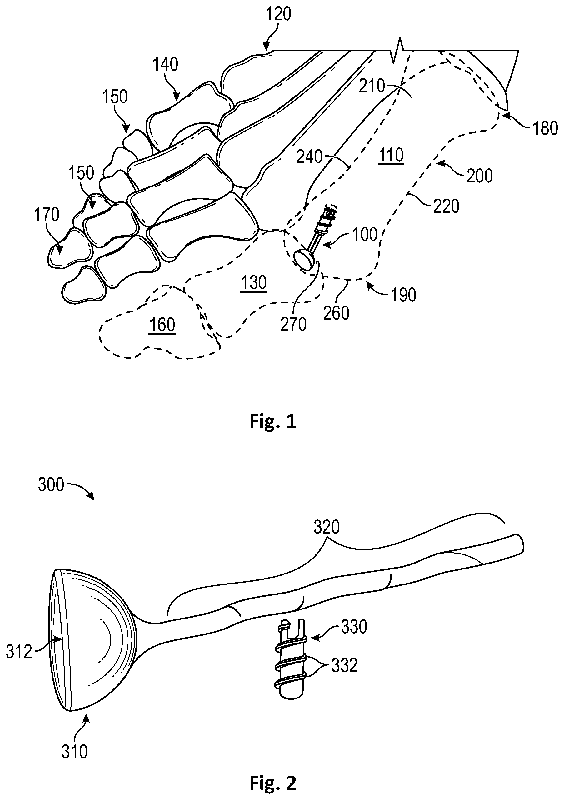 Patent US12472072 — Joint implant apparatus, system, and method — Figure 1