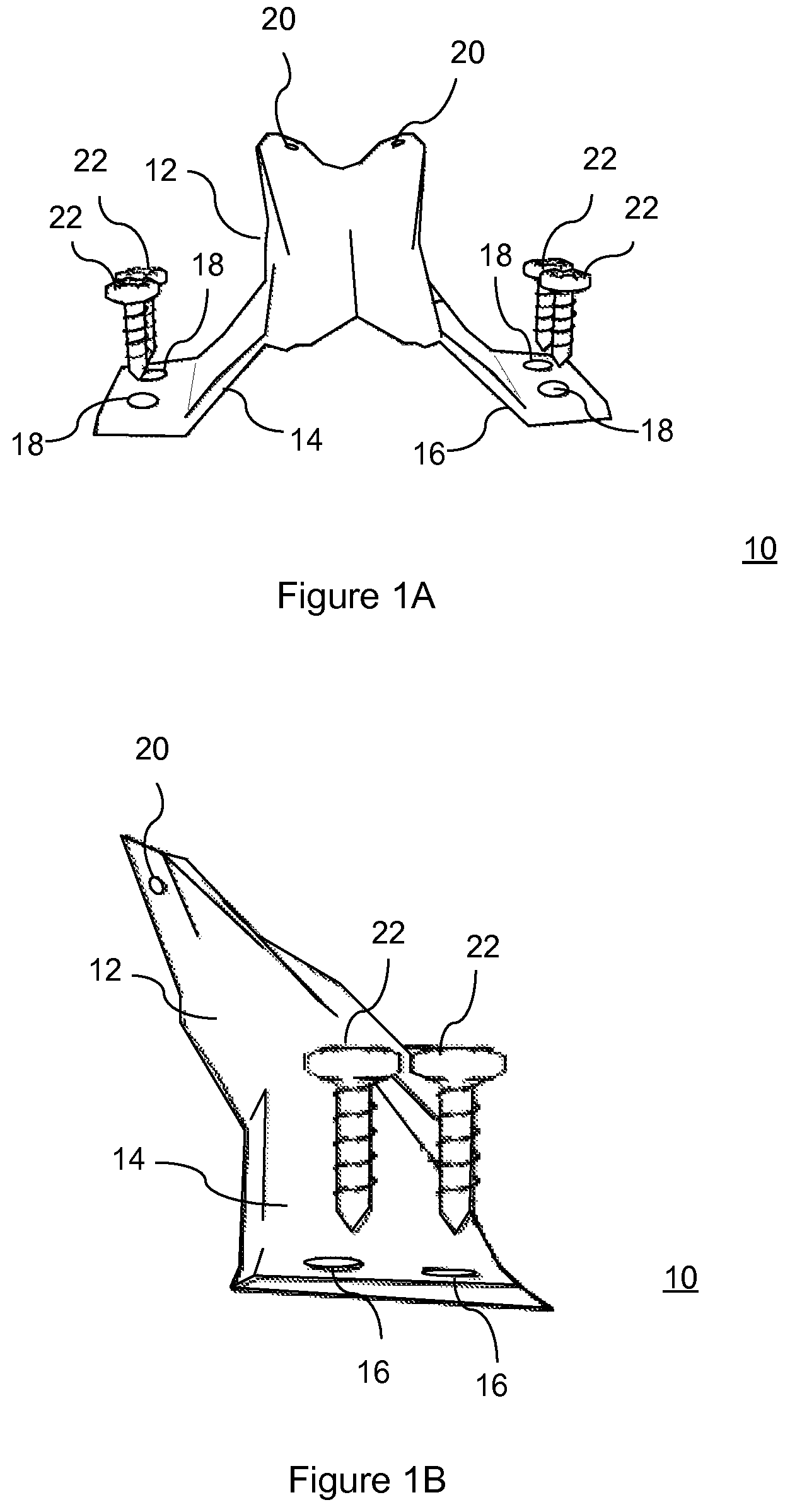 Patent US12472073 — Spinal lamina implant — Figure 1