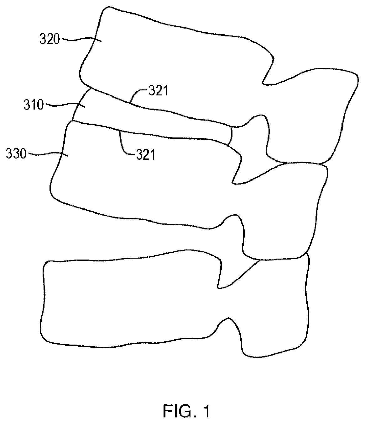 Patent US12472074 Figure 1 – Expandable spinal implant apparatus and method of use