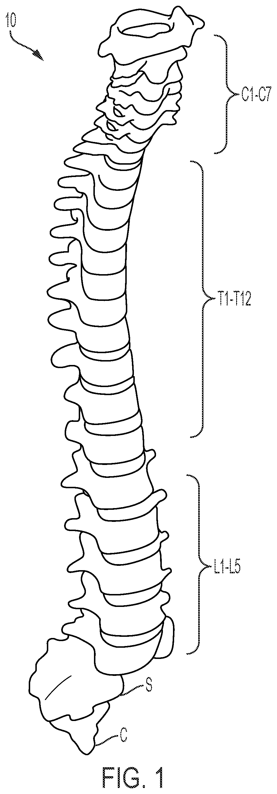 Patent US12472075 Figure 1 – Expandable intervertebral fusion implant