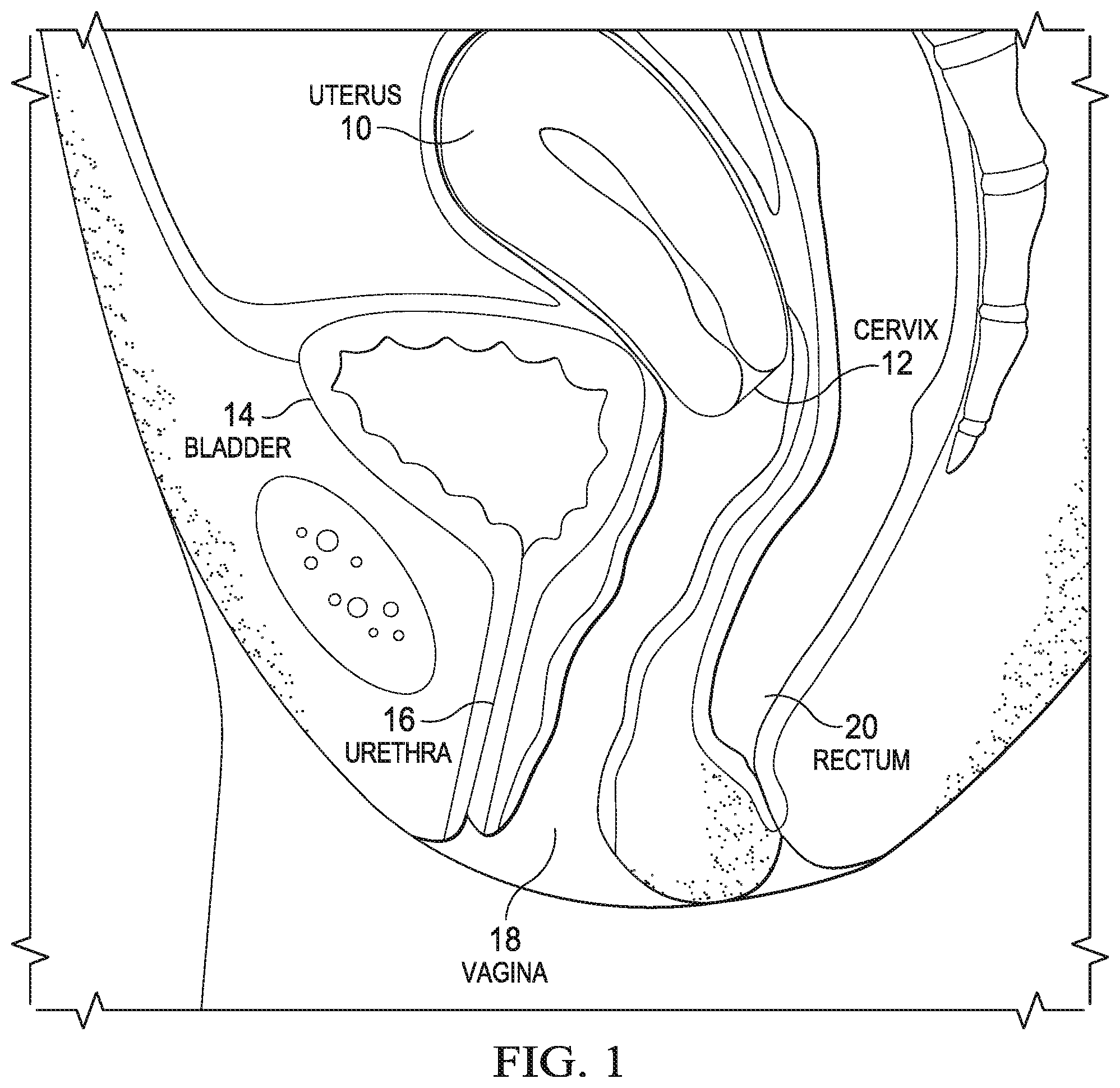 Patent US12472092 — Flexible cone-shaped intra-vaginal support device — Figure 1