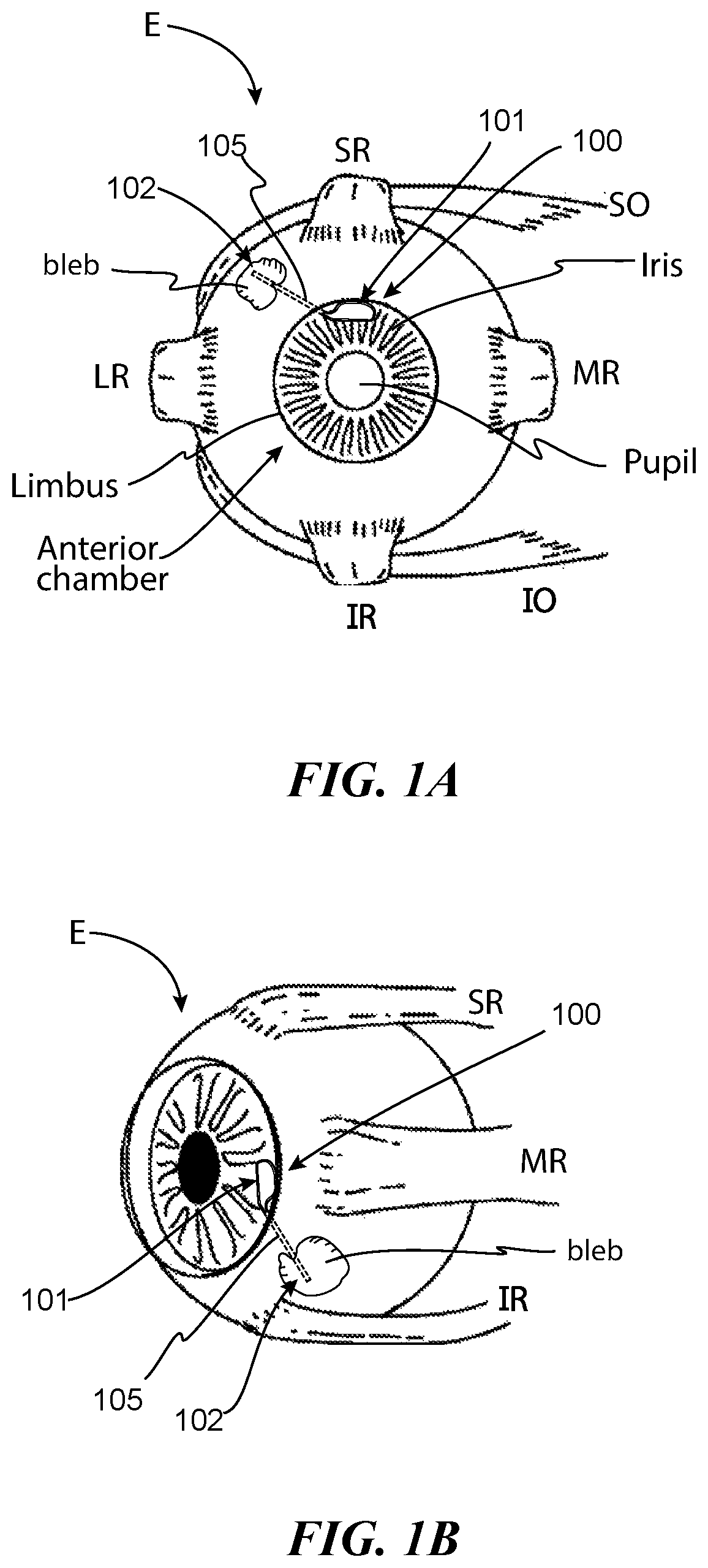 Patent US12472098 — Adjustable flow glaucoma shunts having non-linearly arranged flow control elements, and associated systems and methods — Figure 1