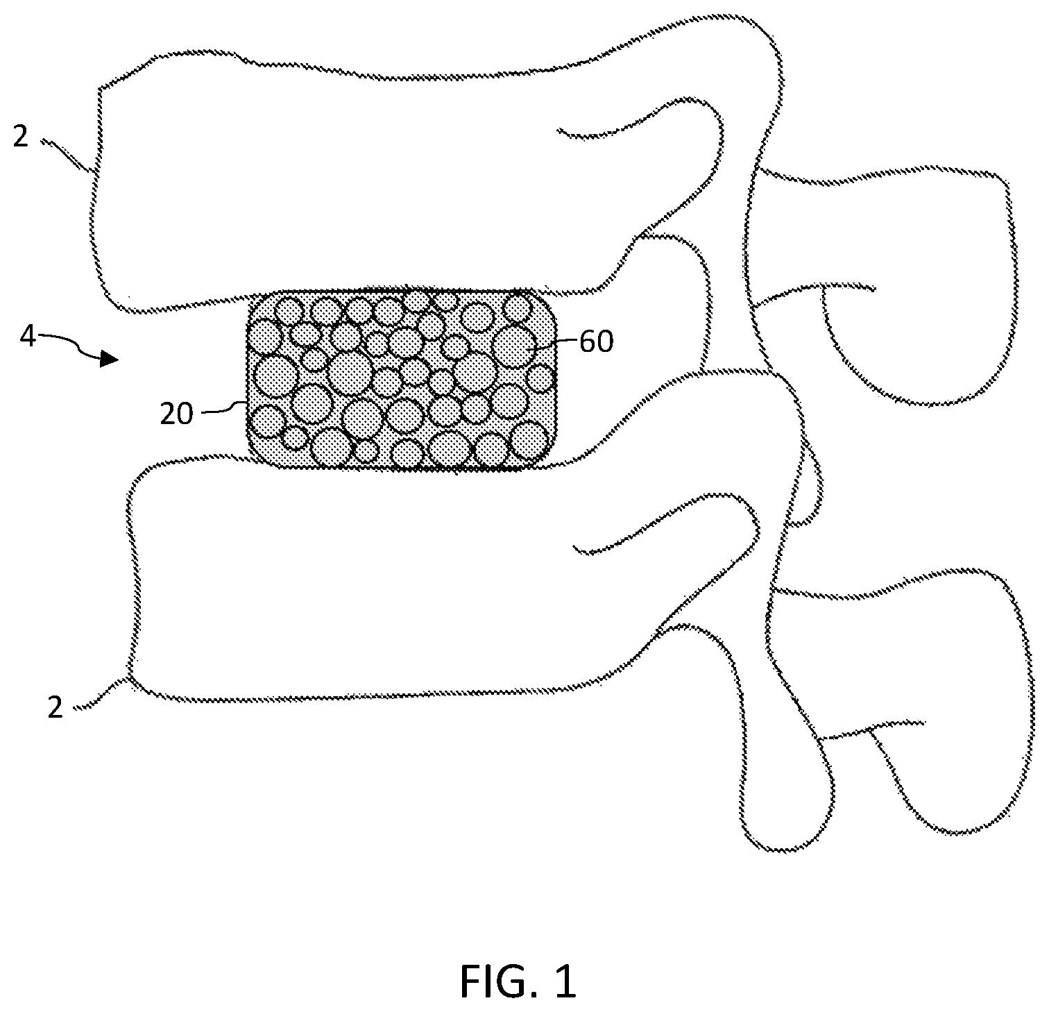 Patent US12472141 — Drug delivery for intervertebral disc pain management — Figure 1