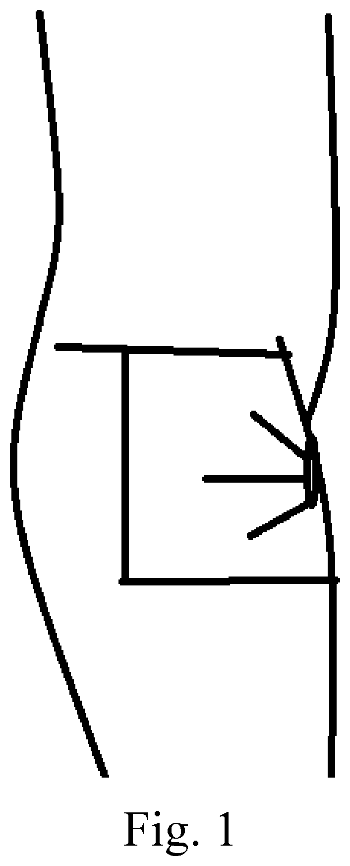 Patent US12472283 — Method of performing a buttocks and hip augmentation using plasma gel — Figure 1
