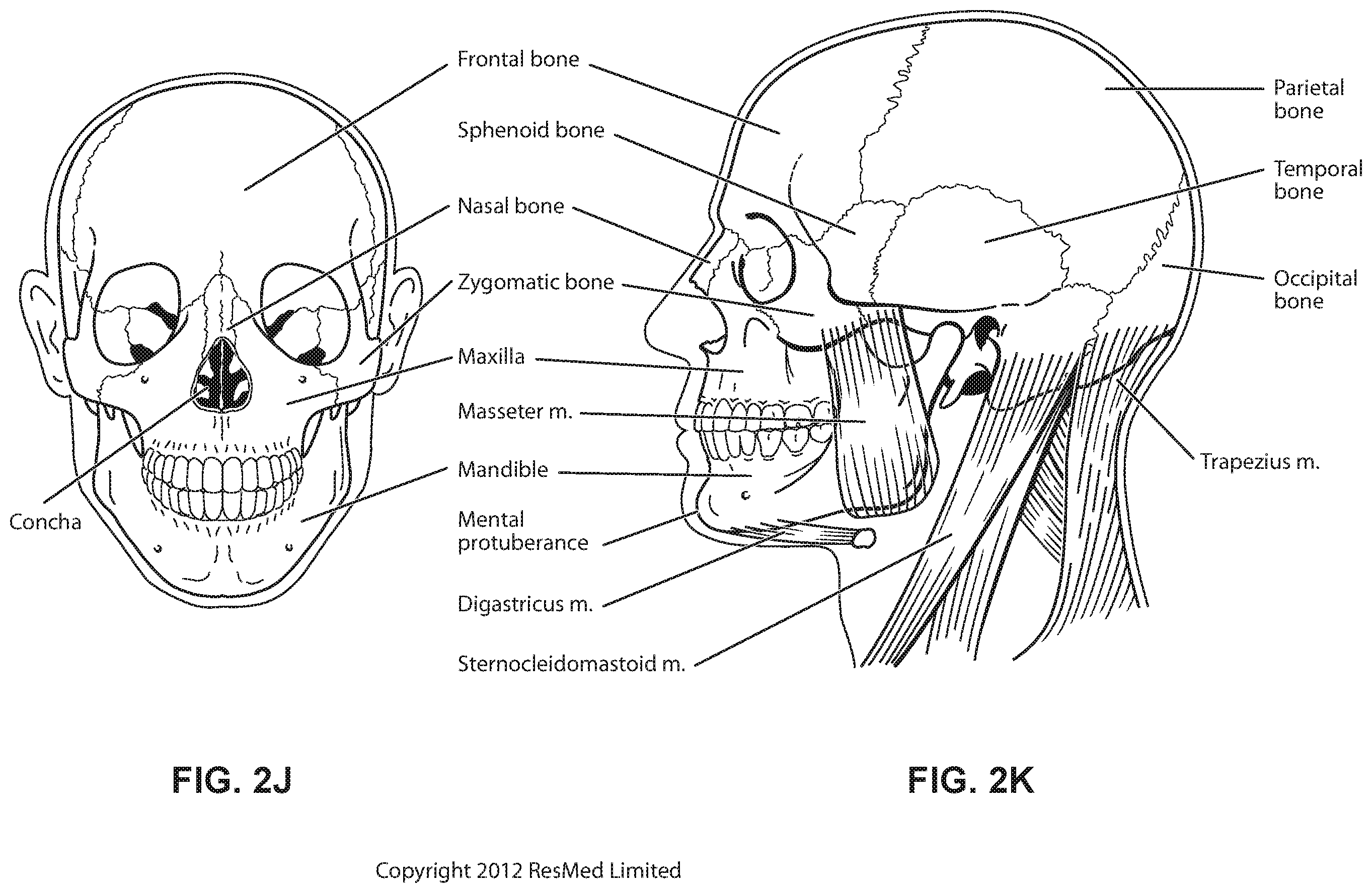 Patent US12472322 Figure 11 – Seal-forming structure for patient interface including textile seal member
