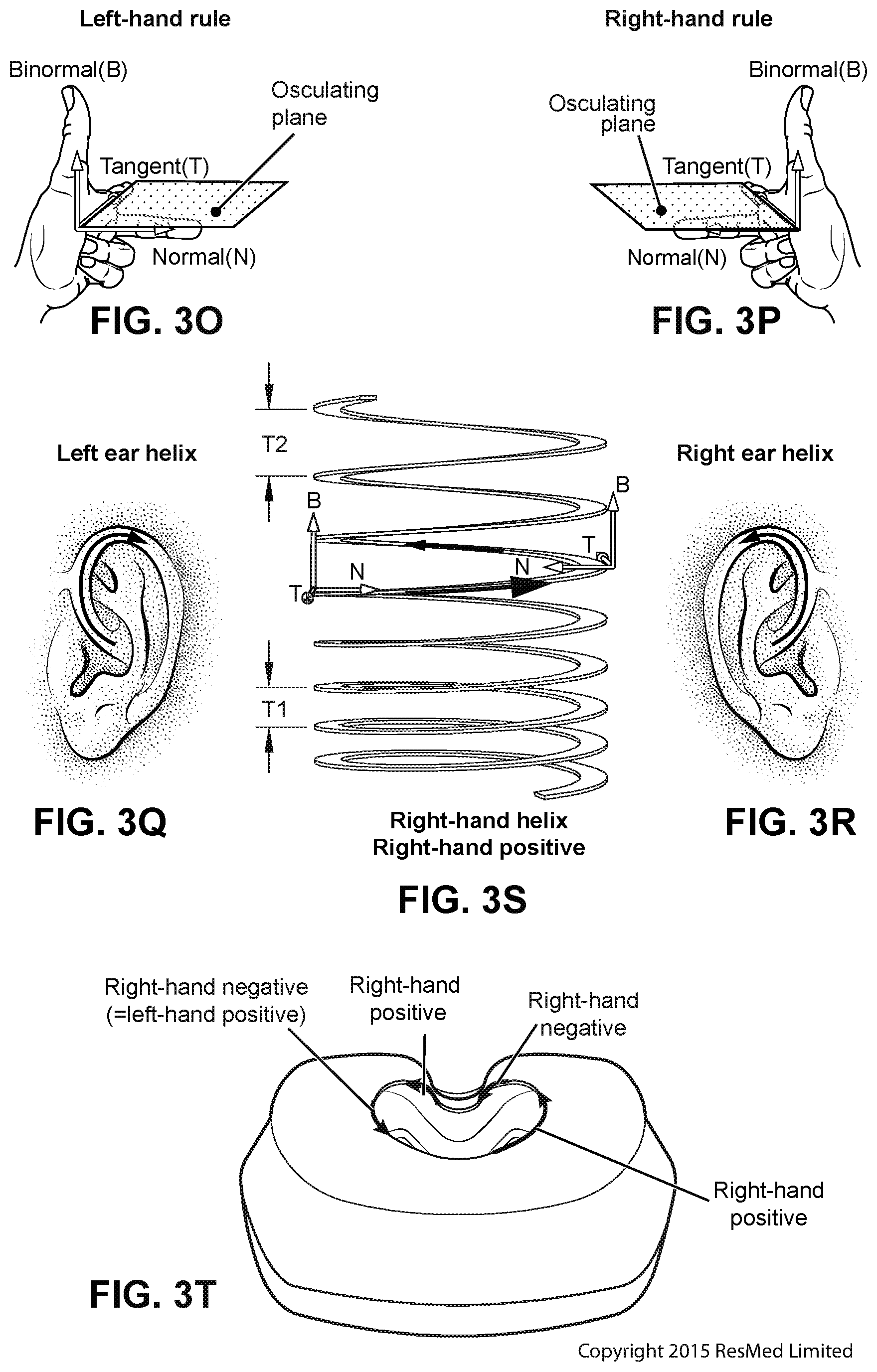 Patent US12472322 Figure 17 – Seal-forming structure for patient interface including textile seal member