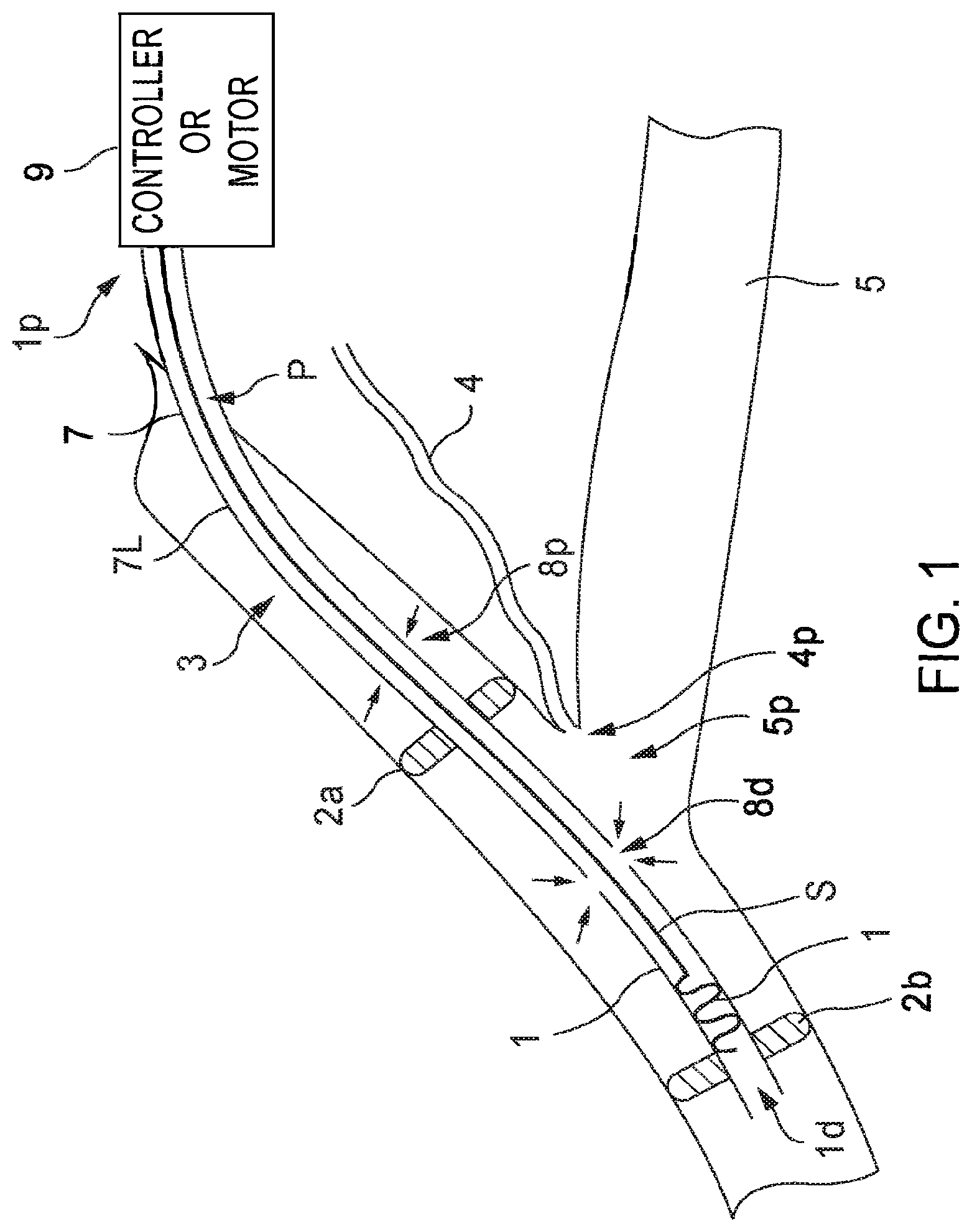 Patent US12472334 — Systems and methods for treatment of fluid overload — Figure 1