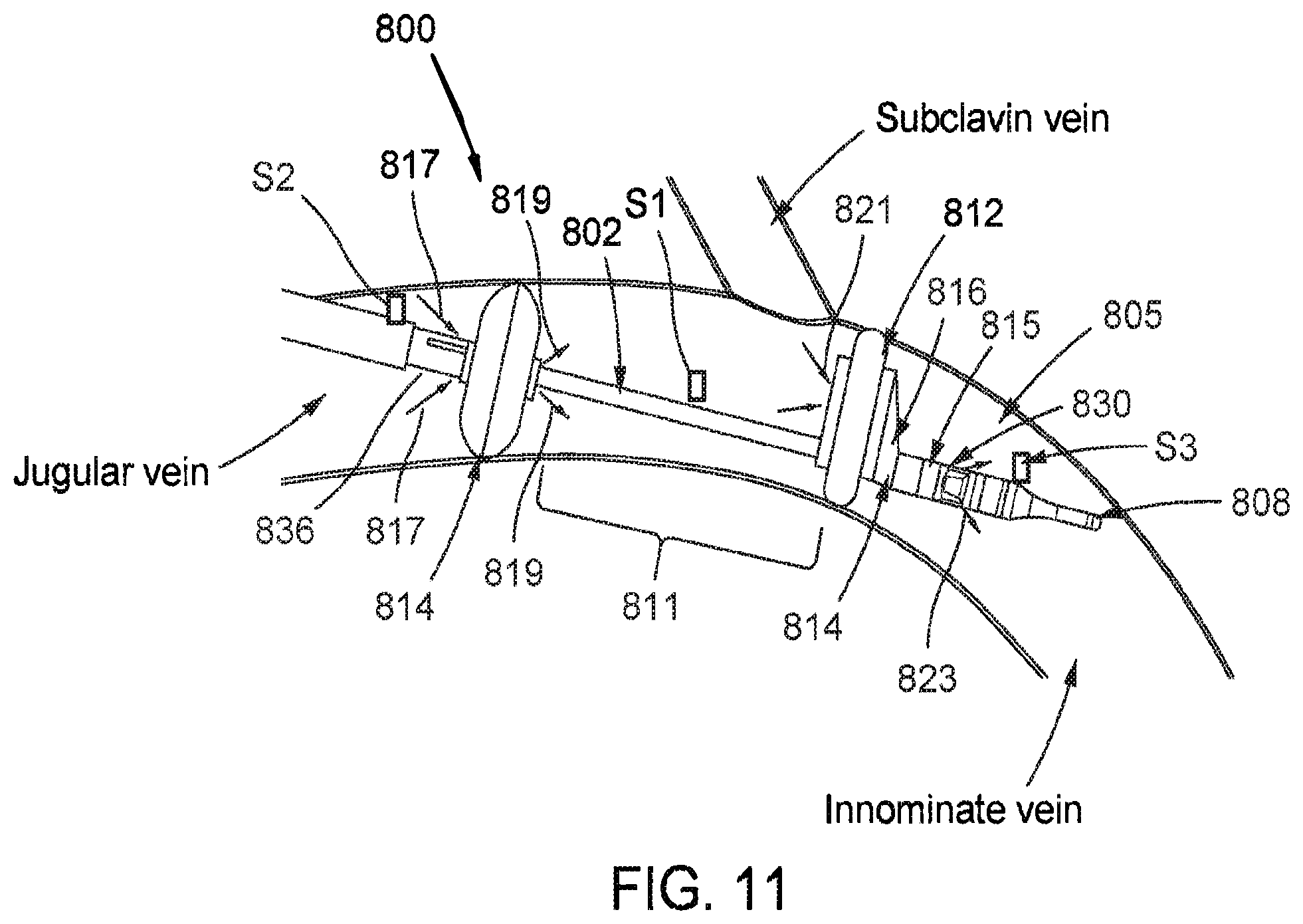 Patent US12472334 Figure 11 – Systems and methods for treatment of fluid overload