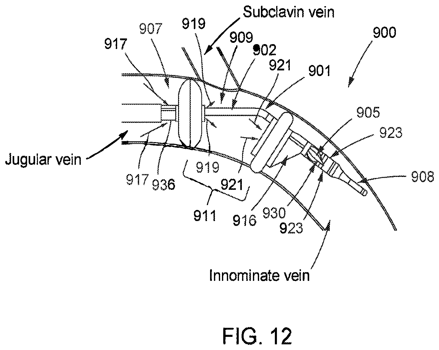 Patent US12472334 Figure 12 – Systems and methods for treatment of fluid overload