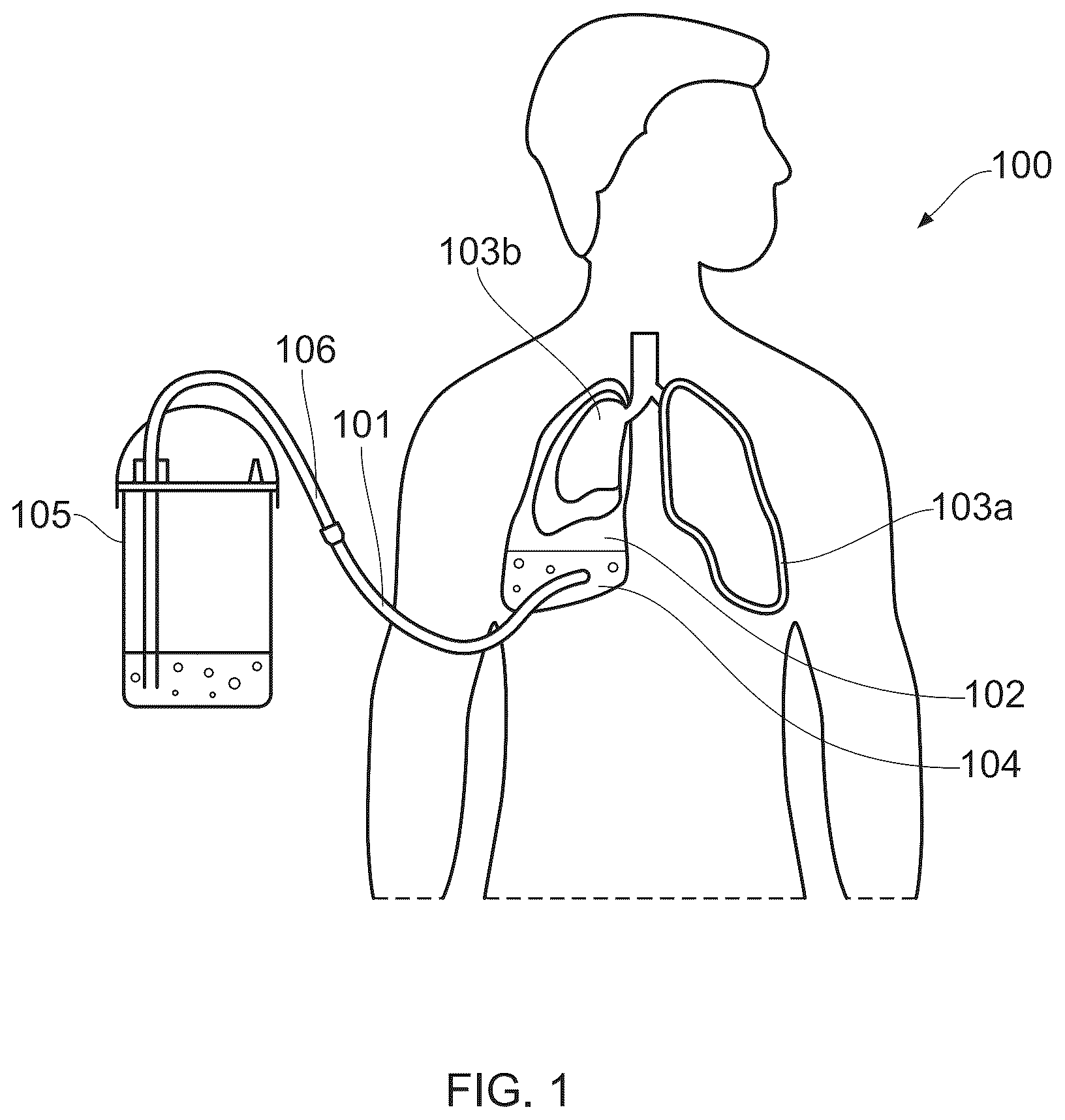 Patent US12472341 — Chest drain connector — Figure 1