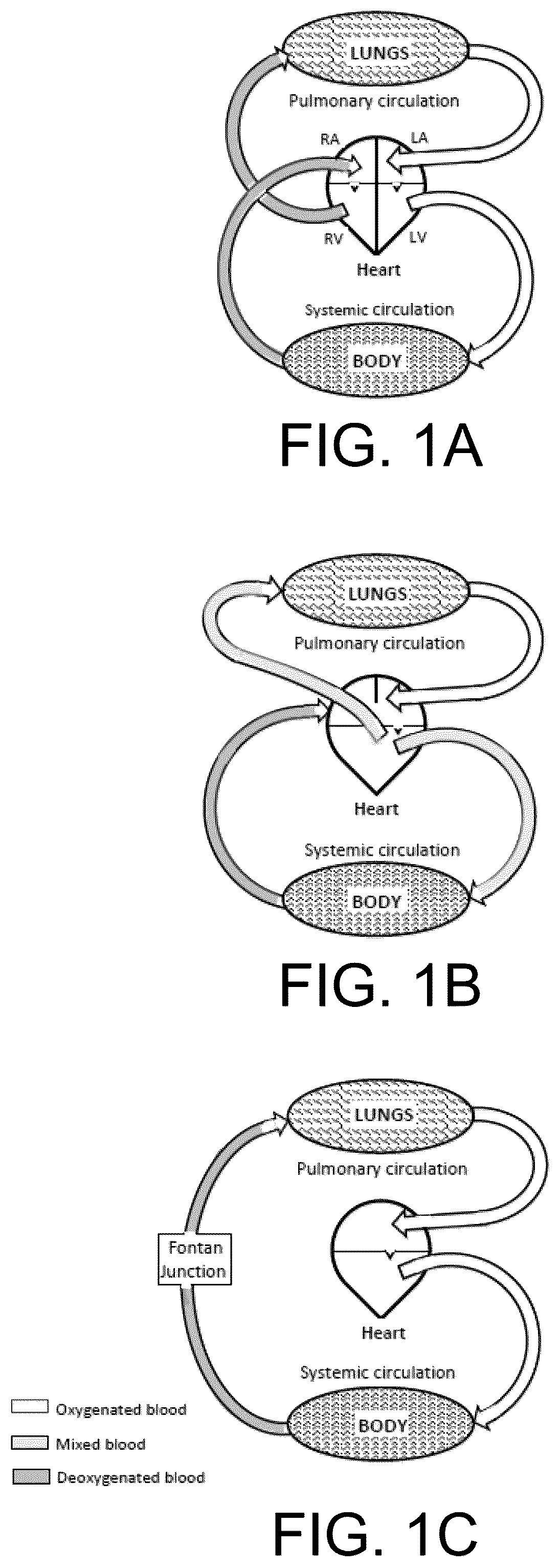 Patent US12472345 — Pulmonary circulation assist implant for a univentricular heart — Figure 1