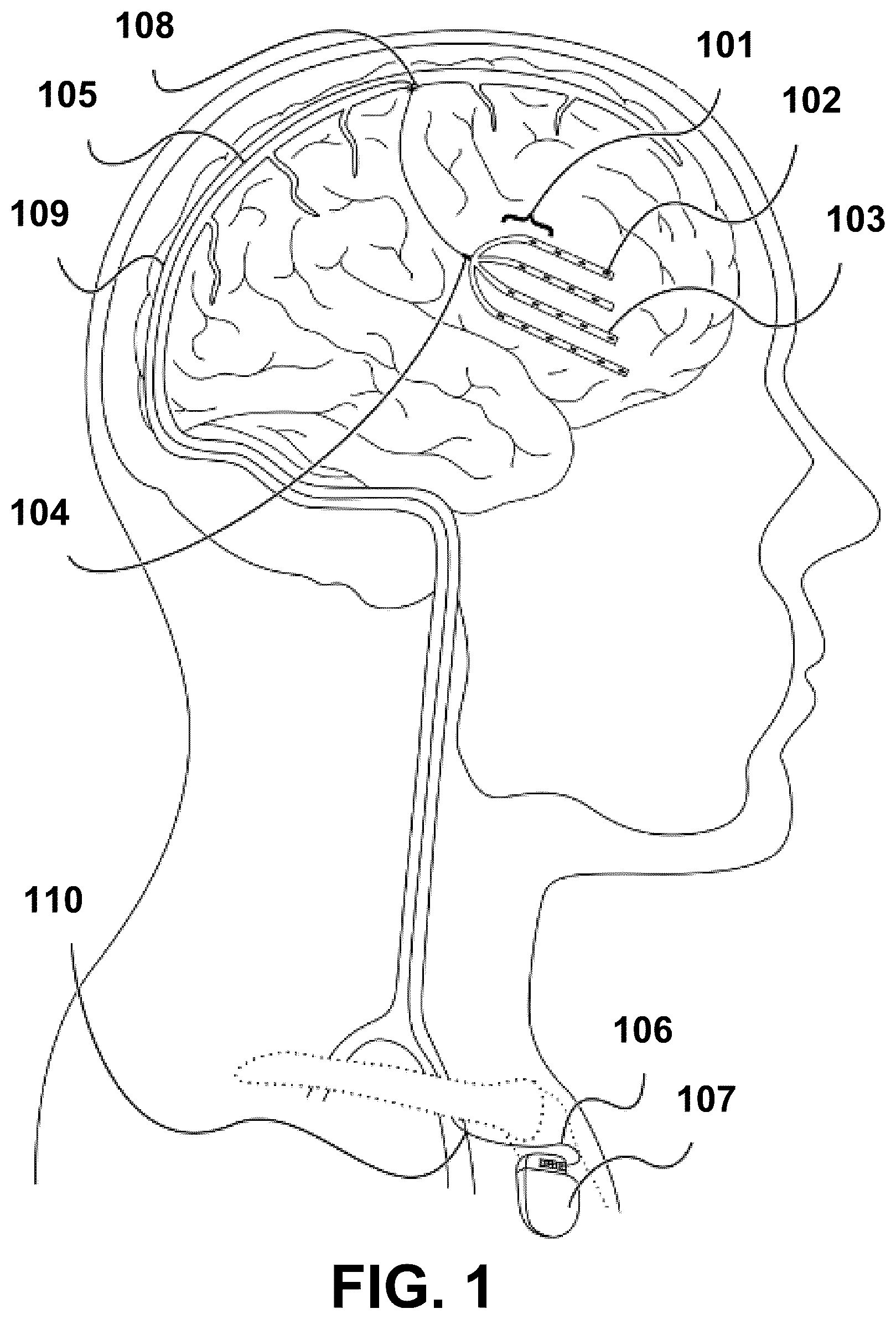 Patent US12472348 — Transcatheter electrode array and use thereof — Figure 1