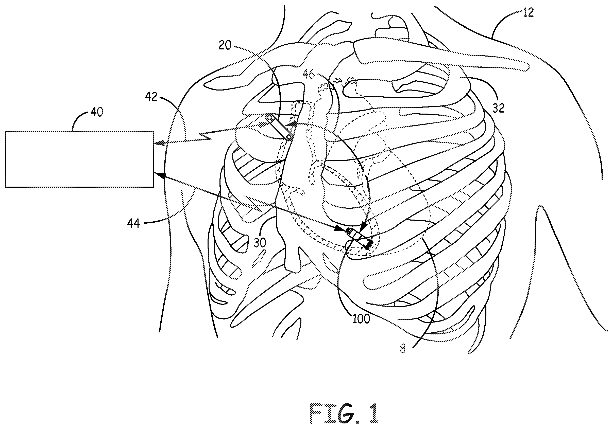 Patent US12472361 — Atrial synchronized ventricular pacing system — Figure 1