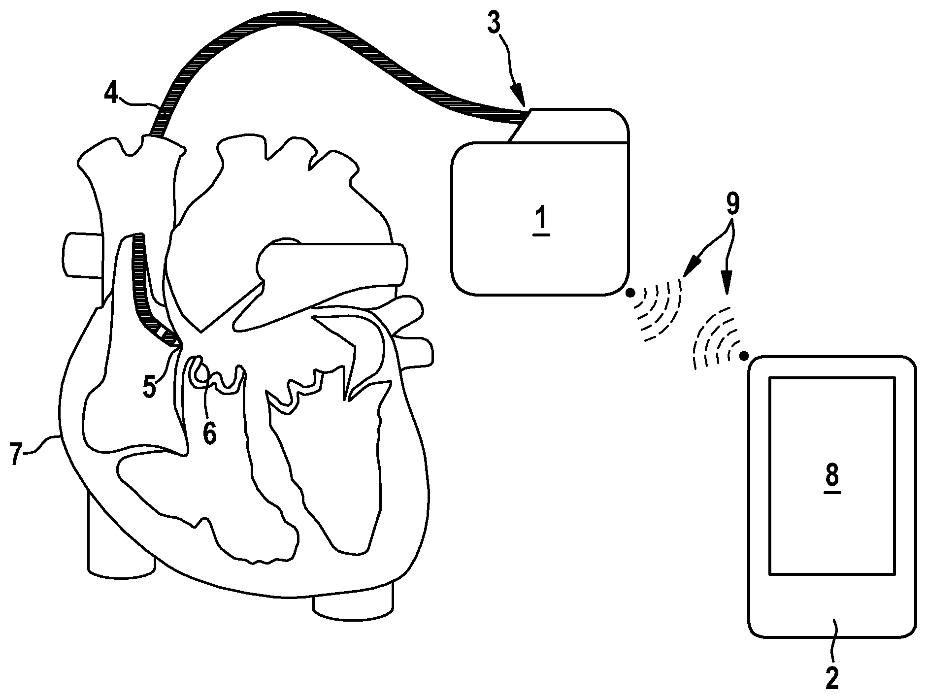 Patent US12472362 Figure 1 – Programming device for programming an implantable medical device for stimulating a human or animal heart