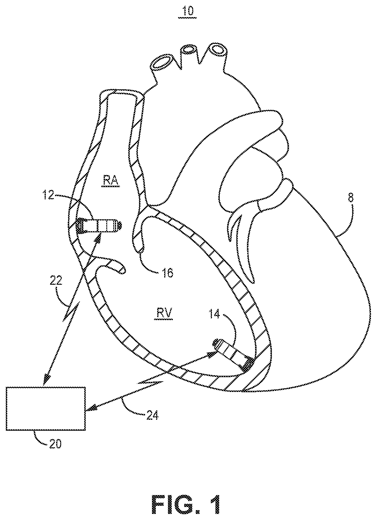 Patent US12472363 — Pacing mode switching in a ventricular pacemaker — Figure 1