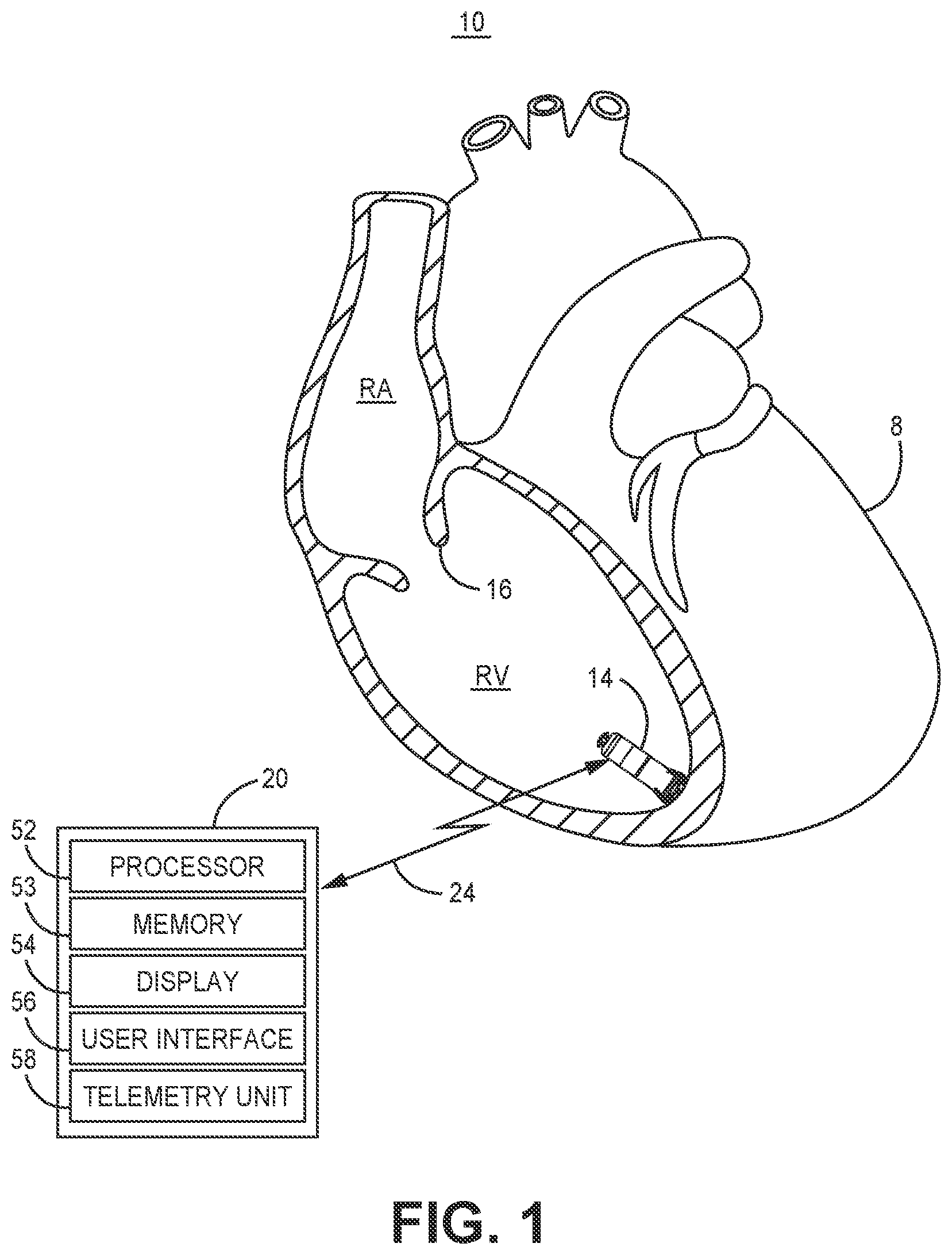 Patent US12472364 Figure 1 – Post-ventricular atrial blanking in a cardiac device