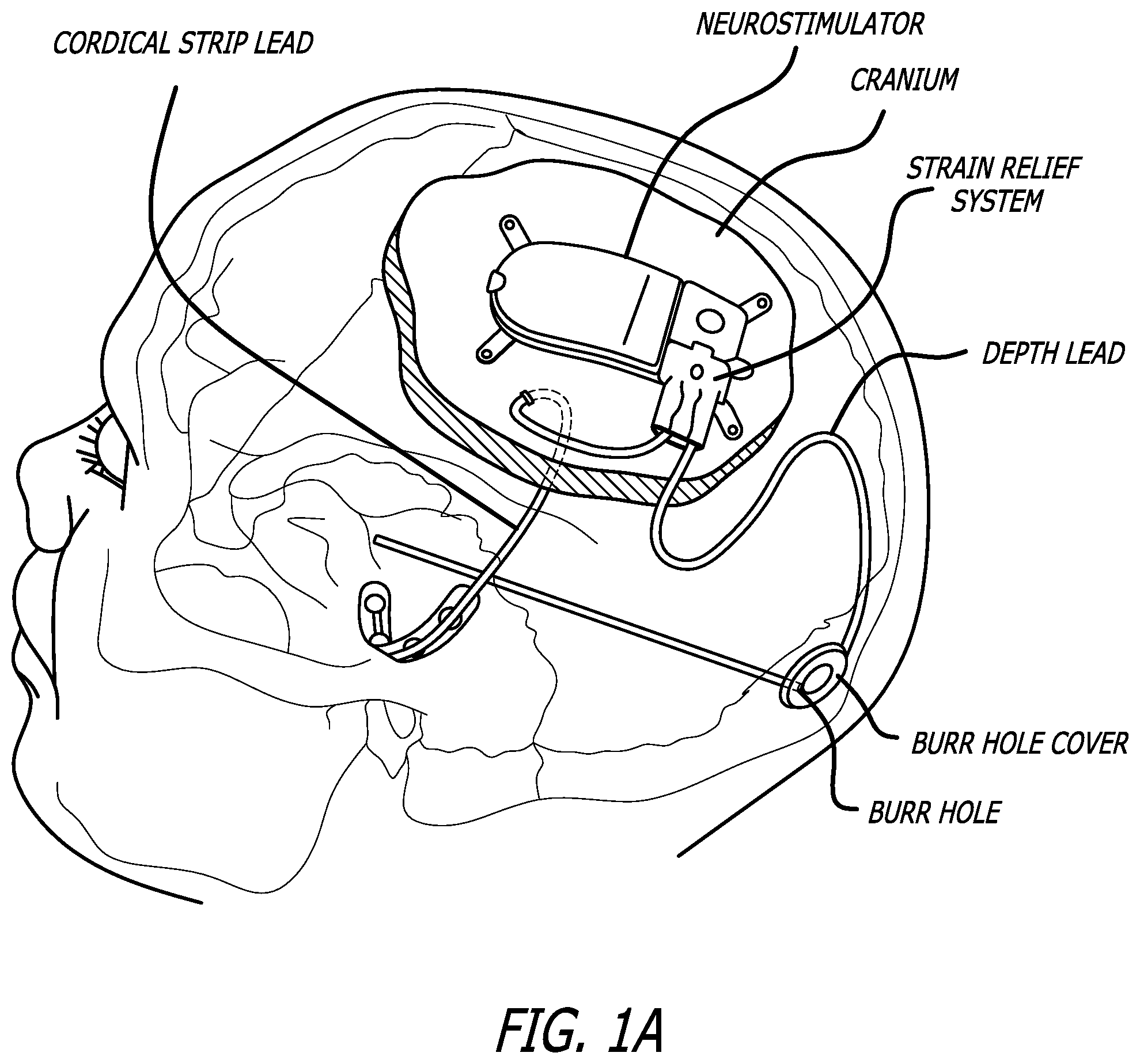 Patent US12472367 — Strain relief systems for active implantable medical devices — Figure 1