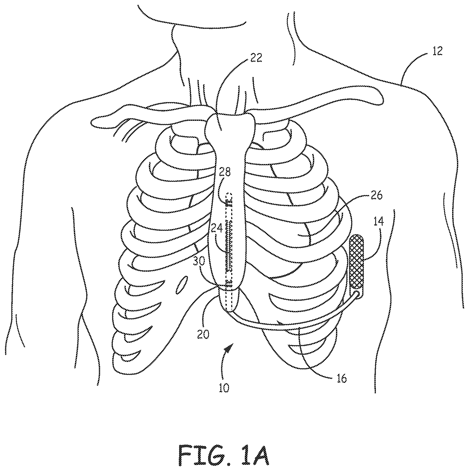 Patent US12472370 Figure 1 – Implantable cardioverter-defibrillator (ICD) system including substernal lead