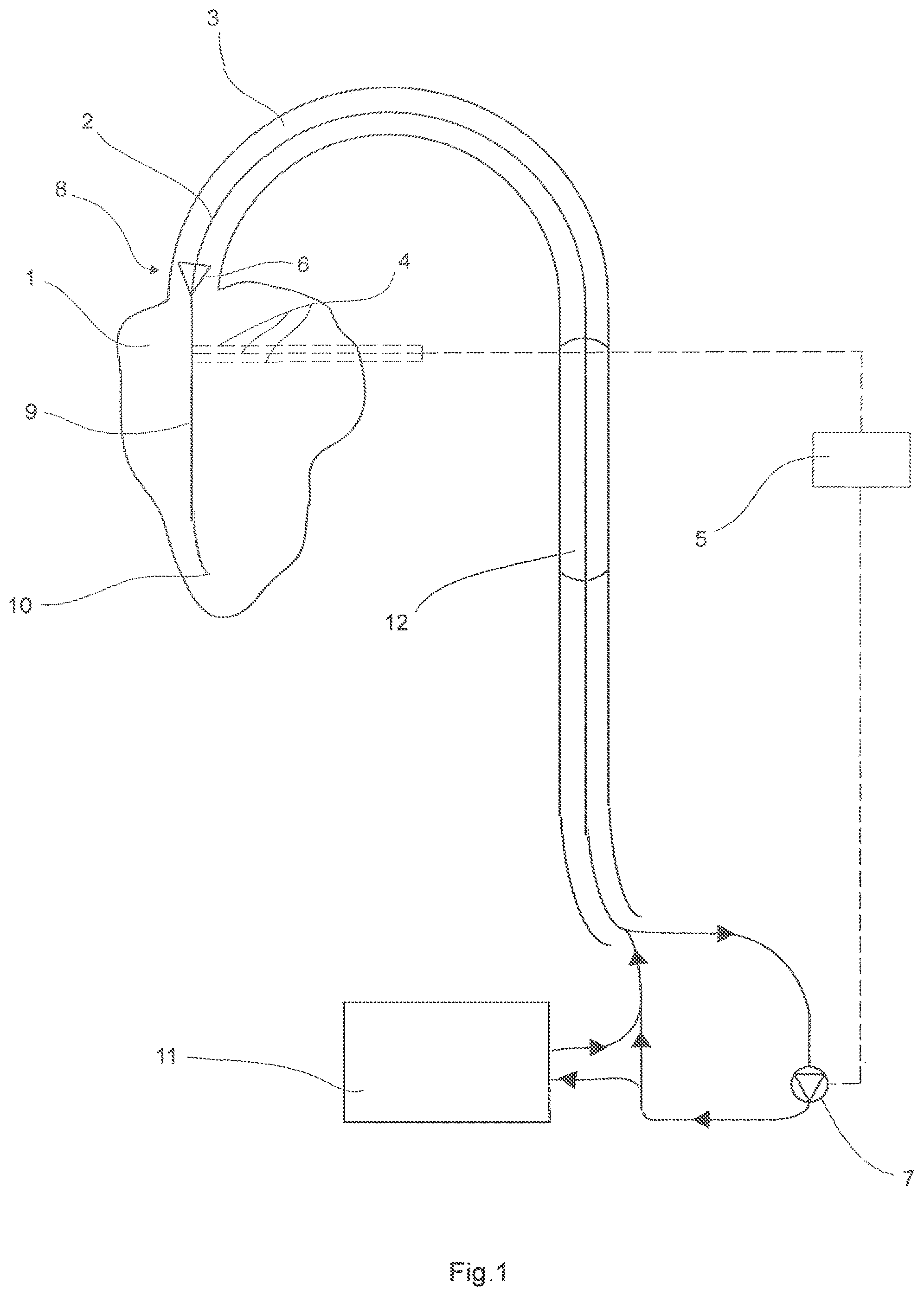 Patent US12480496 Figure 1 – Device to assist the performance of a heart