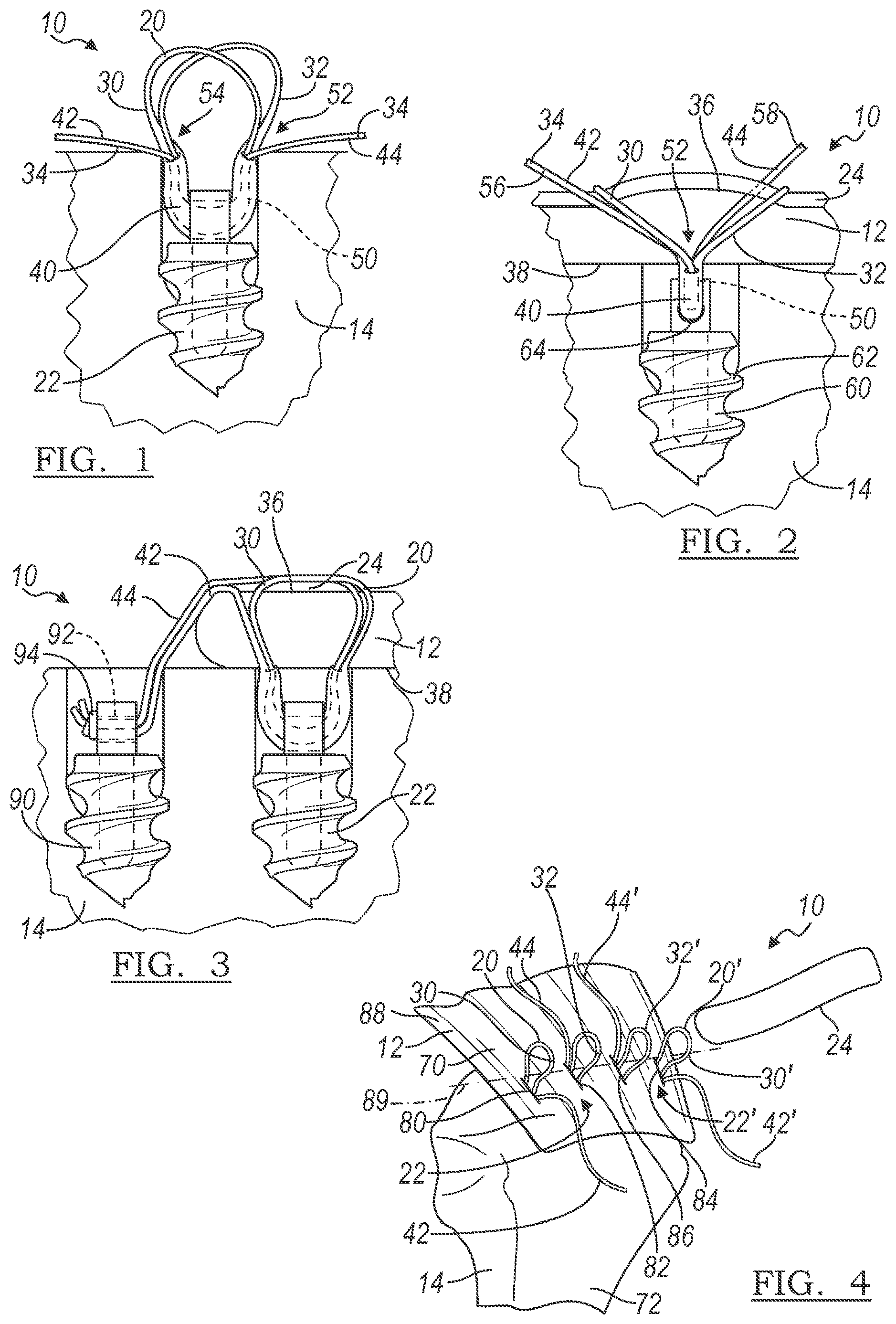 Patent US12496059 — Method and apparatus for soft tissue fixation — Figure 1