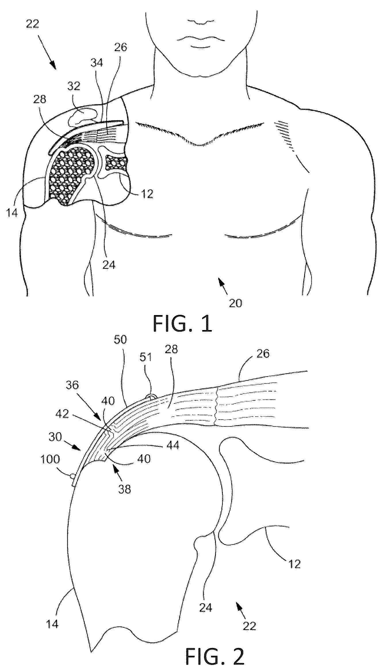 Patent US12496062 — Bone anchor delivery system — Figure 1