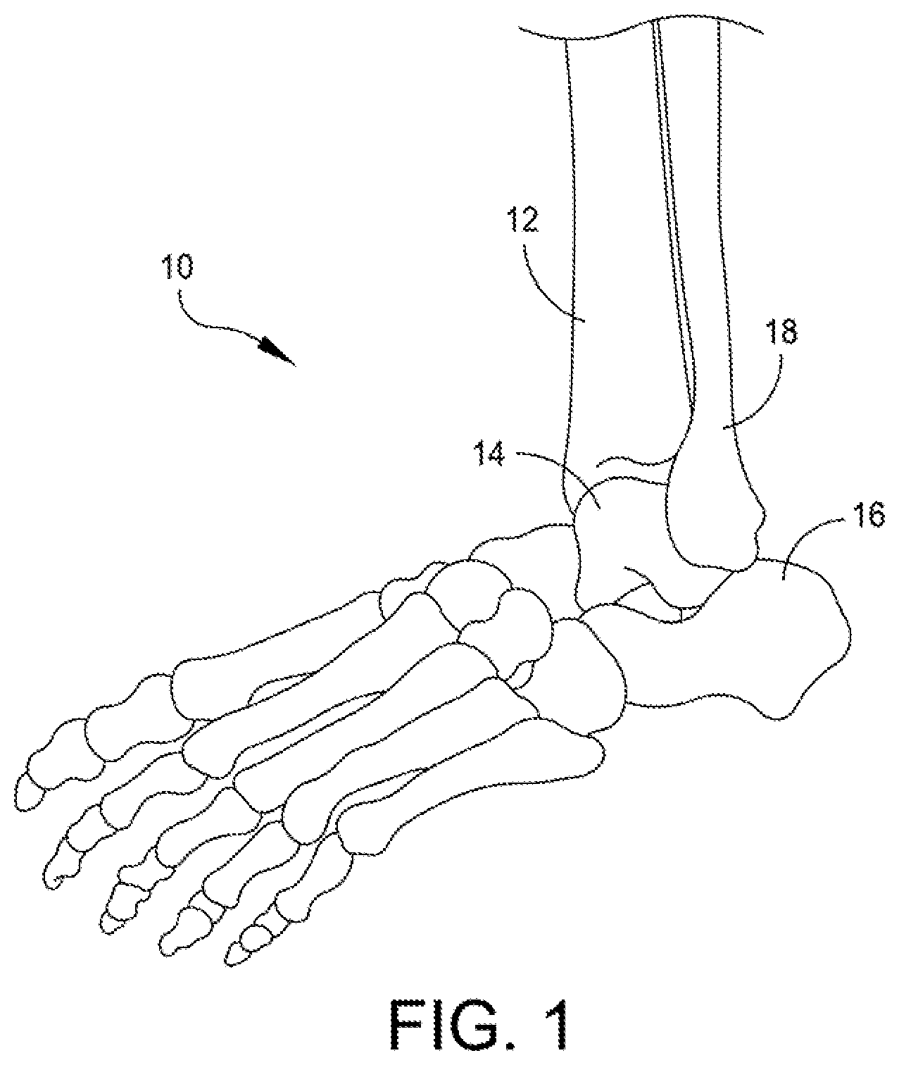 Patent US12496072 — Multi-modal patient-specific surgical guides — Figure 1