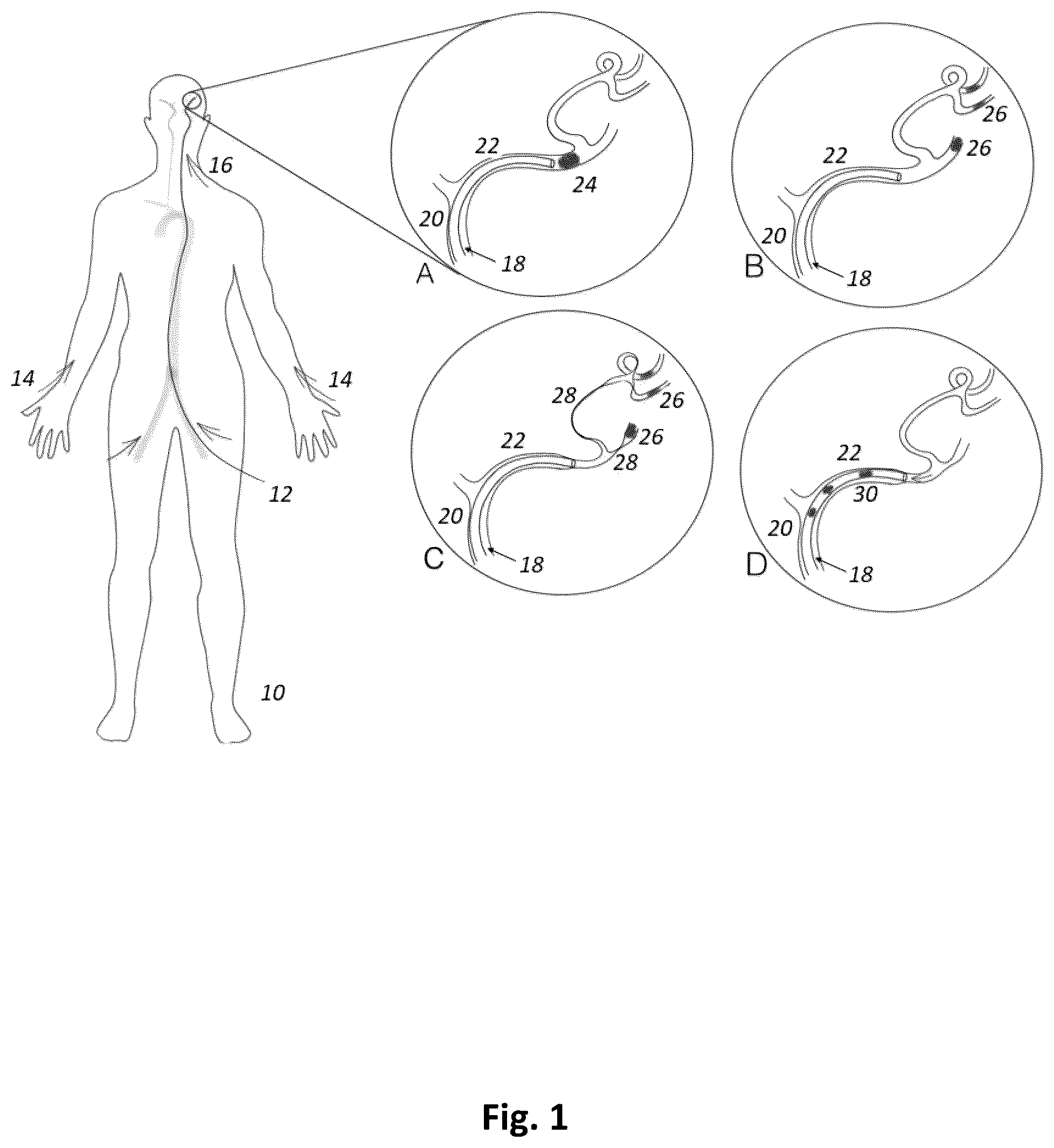 Patent US12496075 — Heart rate synchronous aspiration system and method for treatment of ischemic stroke — Figure 1