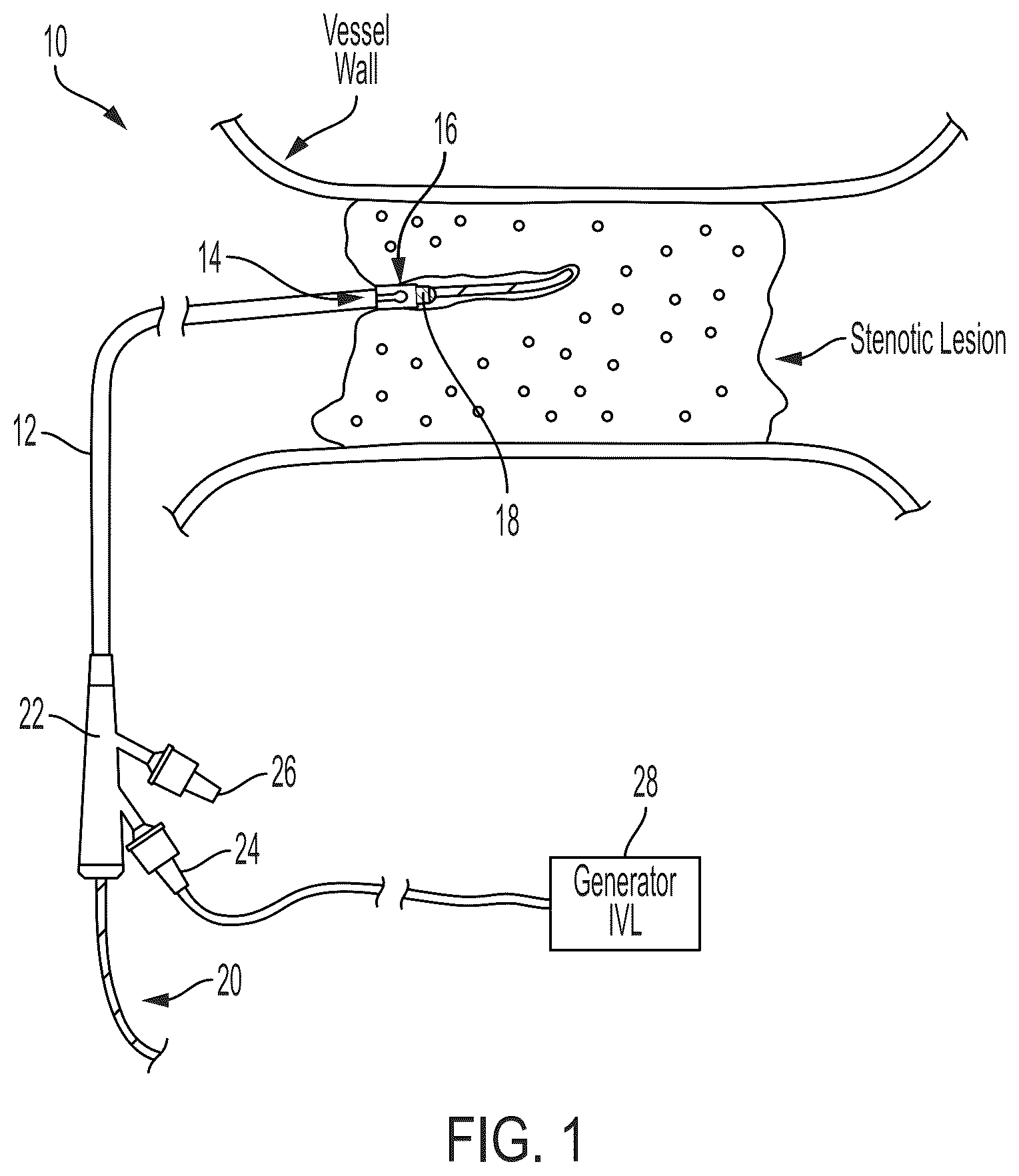Patent US12496078 — Lithotripsy catheters having electrodes formed in metallization layers — Figure 1