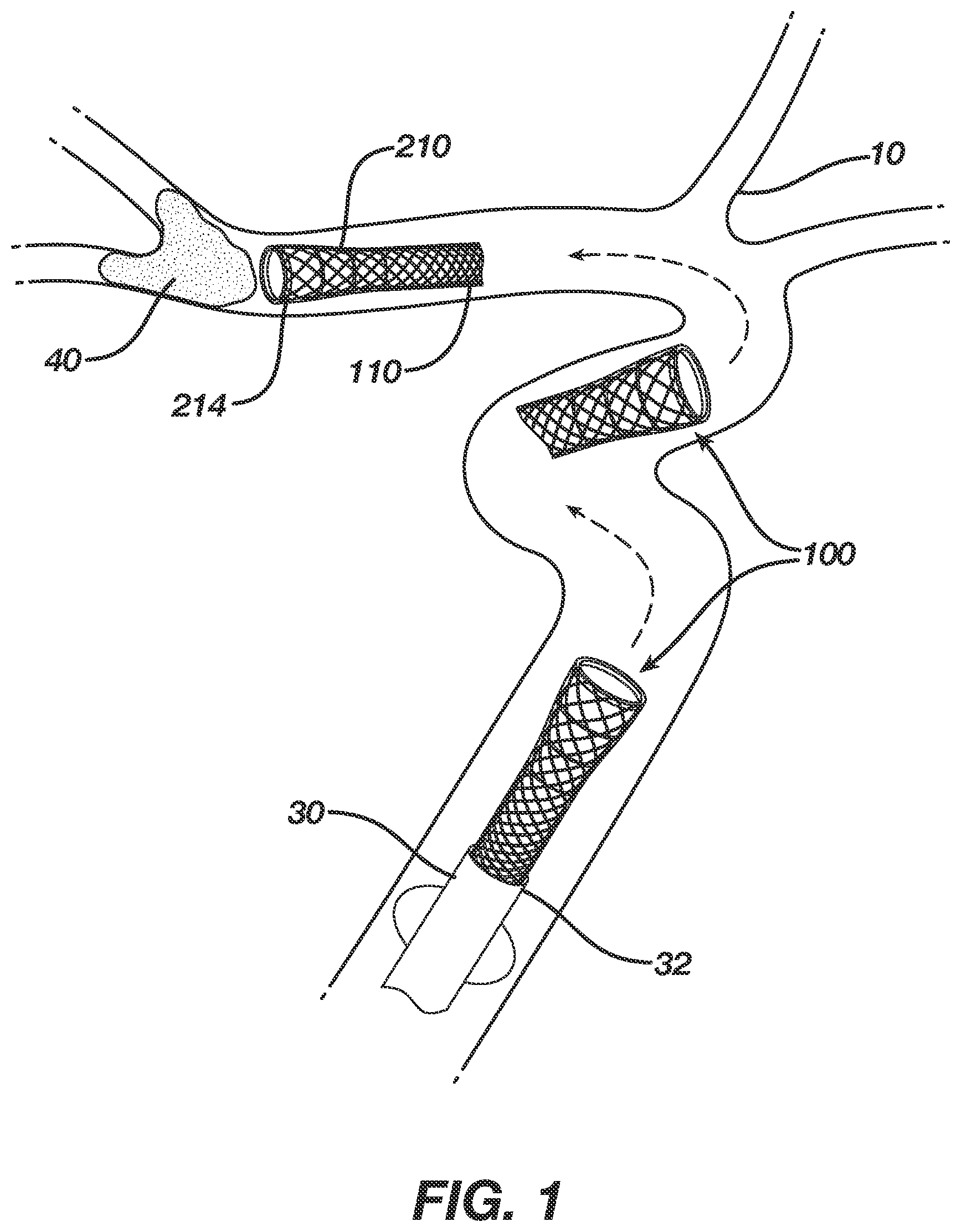 Patent US12496080 — Super-bore catheter with braid supported flared tip — Figure 1