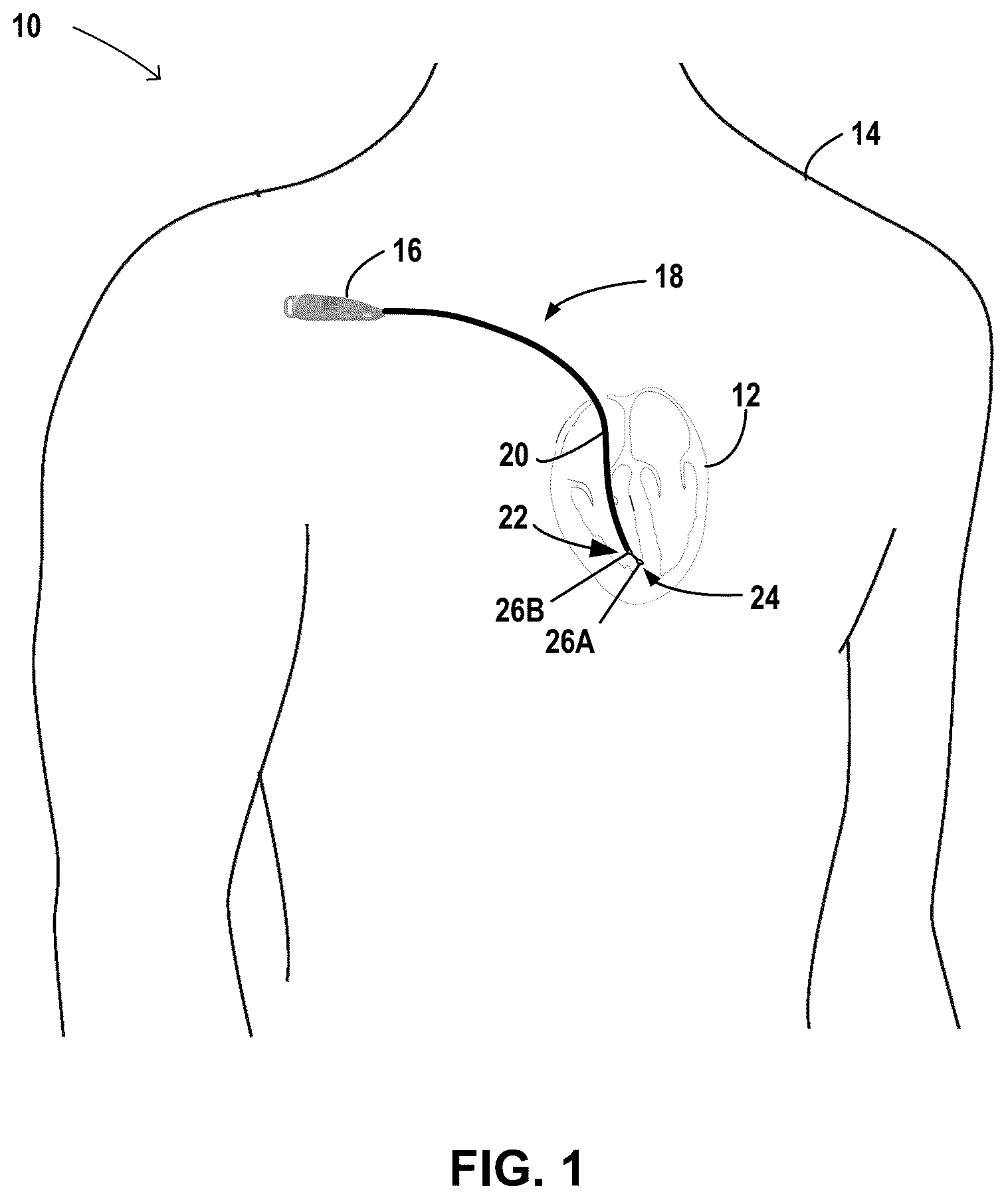 Patent US12496084 — Tunneling and insertion tool for implantable medical device — Figure 1