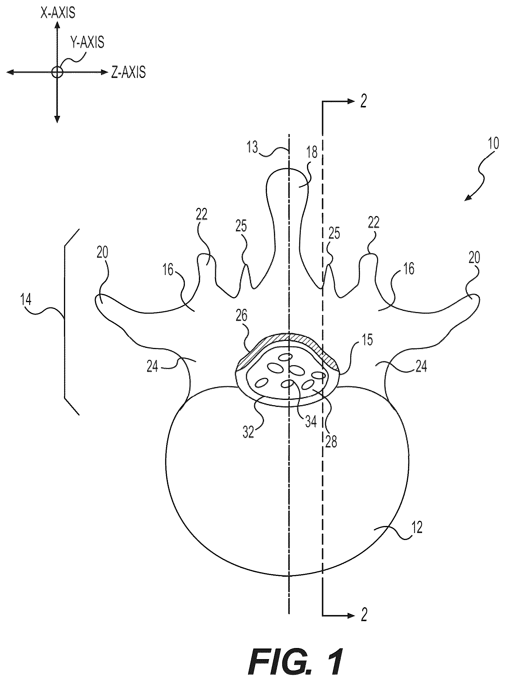 Patent US12496085 — Percutaneous lateral recess resection methods and instruments — Figure 1