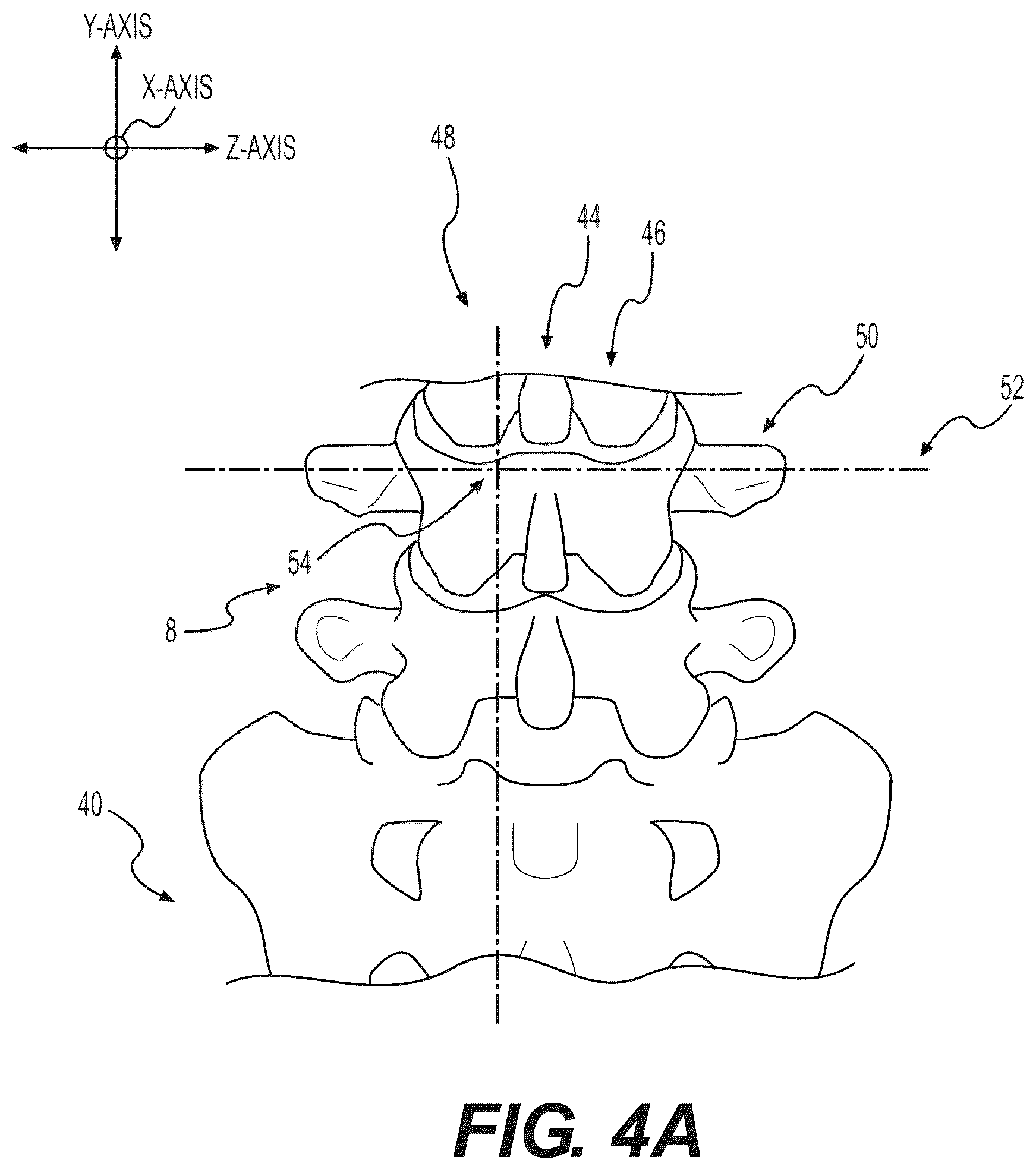 Patent US12496085 Figure 10 – Percutaneous lateral recess resection methods and instruments