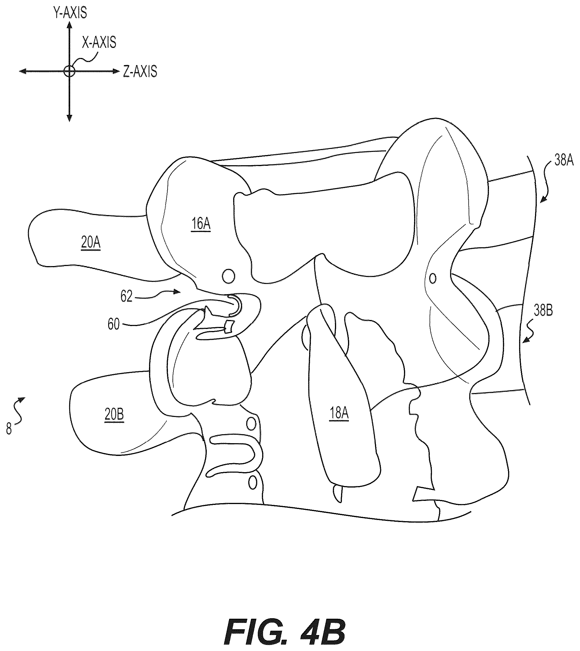 Patent US12496085 Figure 11 – Percutaneous lateral recess resection methods and instruments