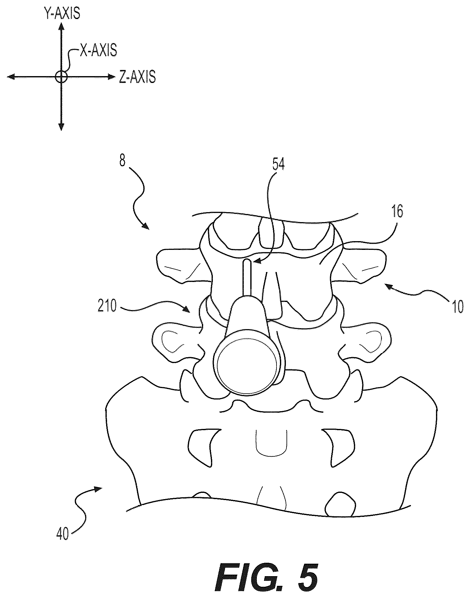 Patent US12496085 Figure 12 – Percutaneous lateral recess resection methods and instruments