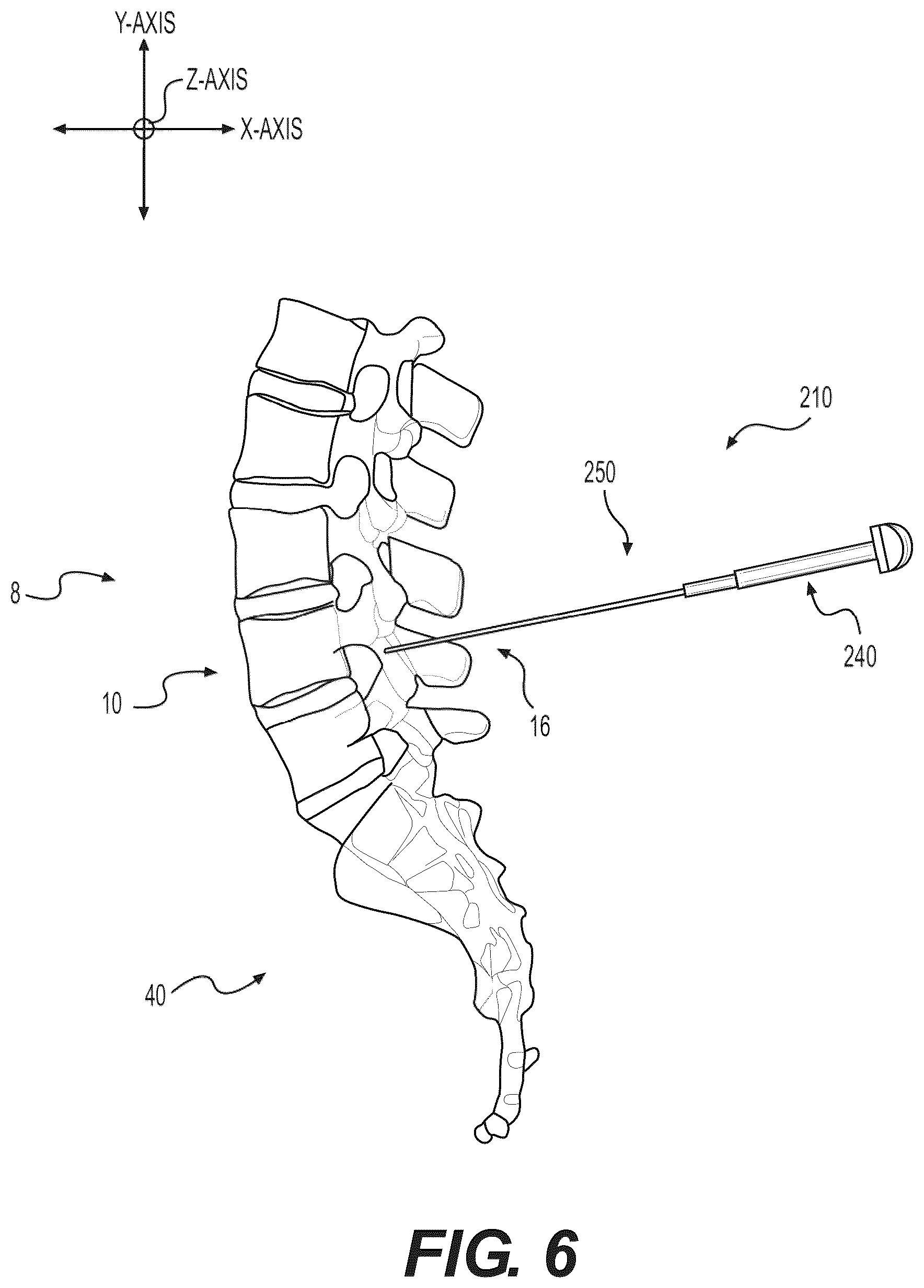 Patent US12496085 Figure 13 – Percutaneous lateral recess resection methods and instruments