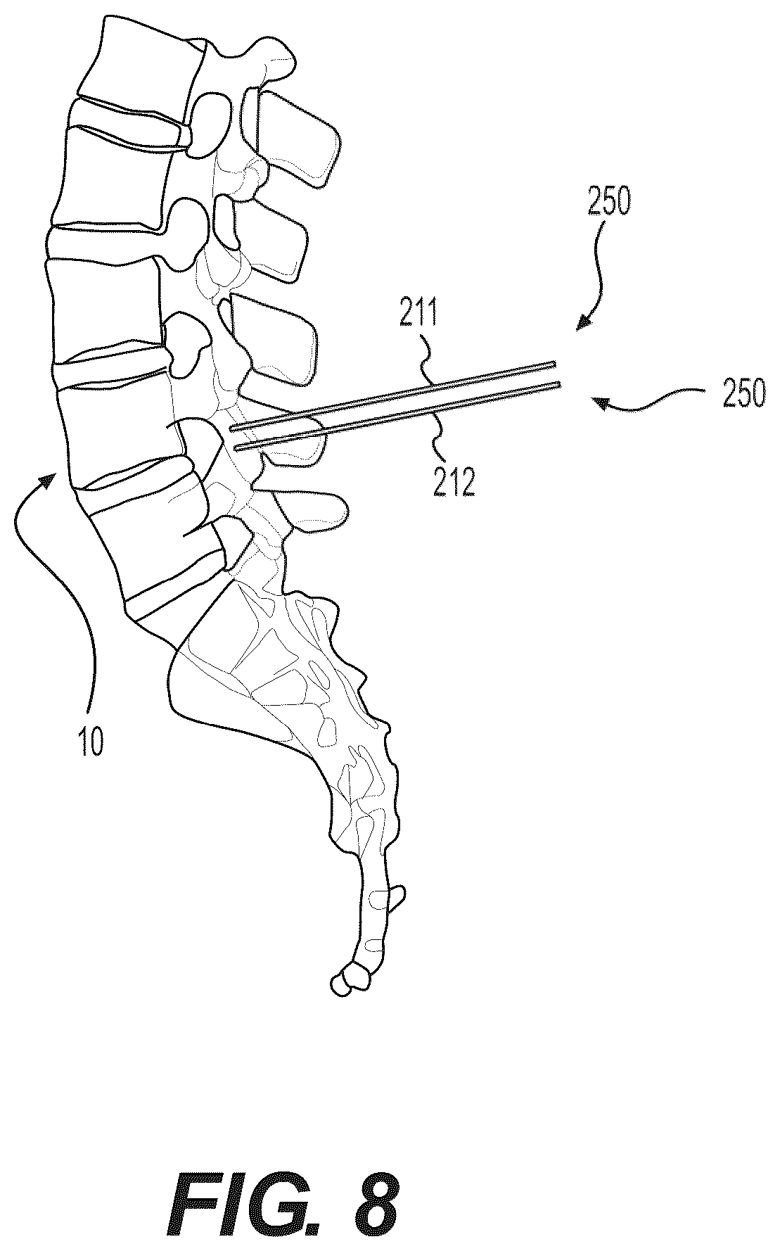 Patent US12496085 Figure 15 – Percutaneous lateral recess resection methods and instruments