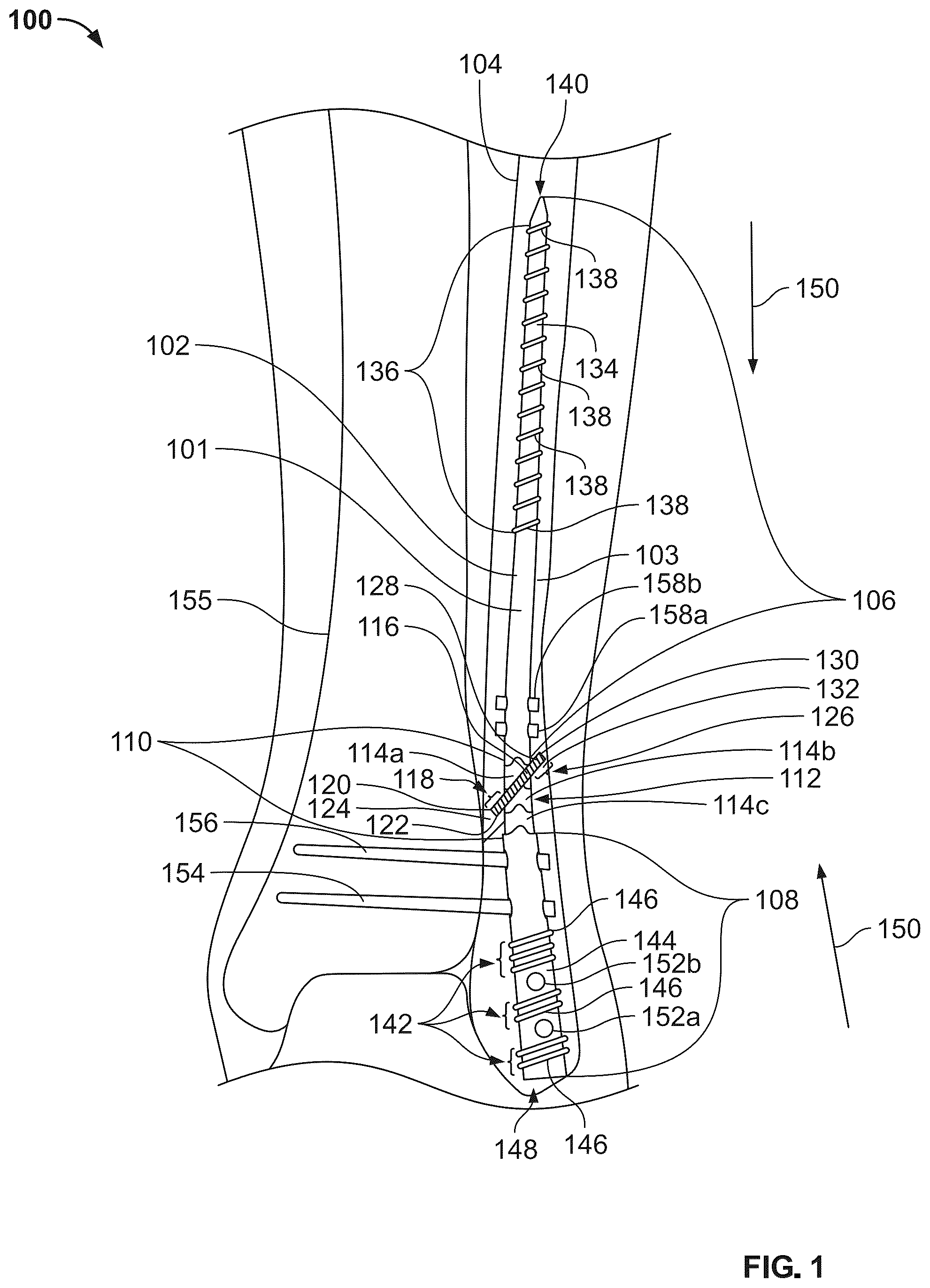 Patent US12496104 — Intramedullary bone fixation devices, systems, and methods — Figure 1
