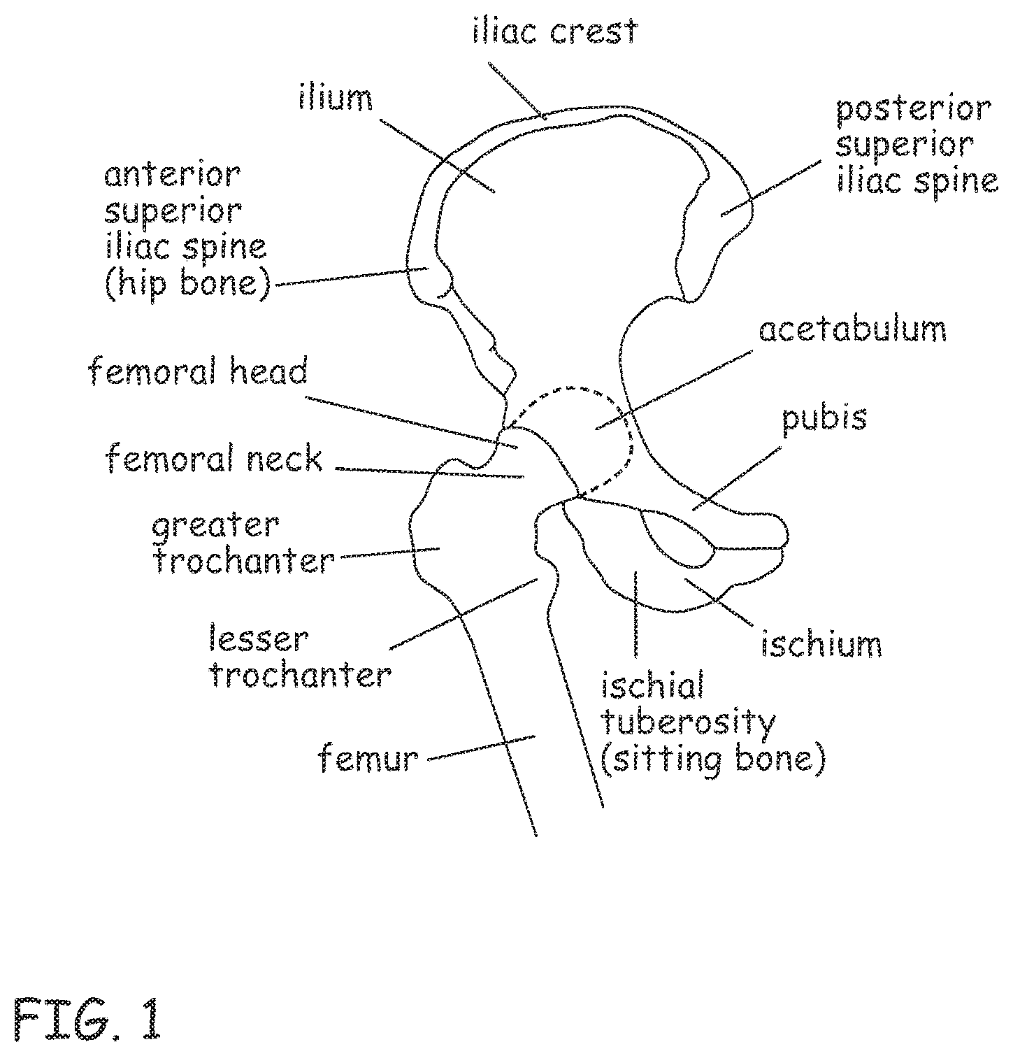 Patent US12496106 — Devices, methods and systems for remedying or preventing fractures — Figure 1