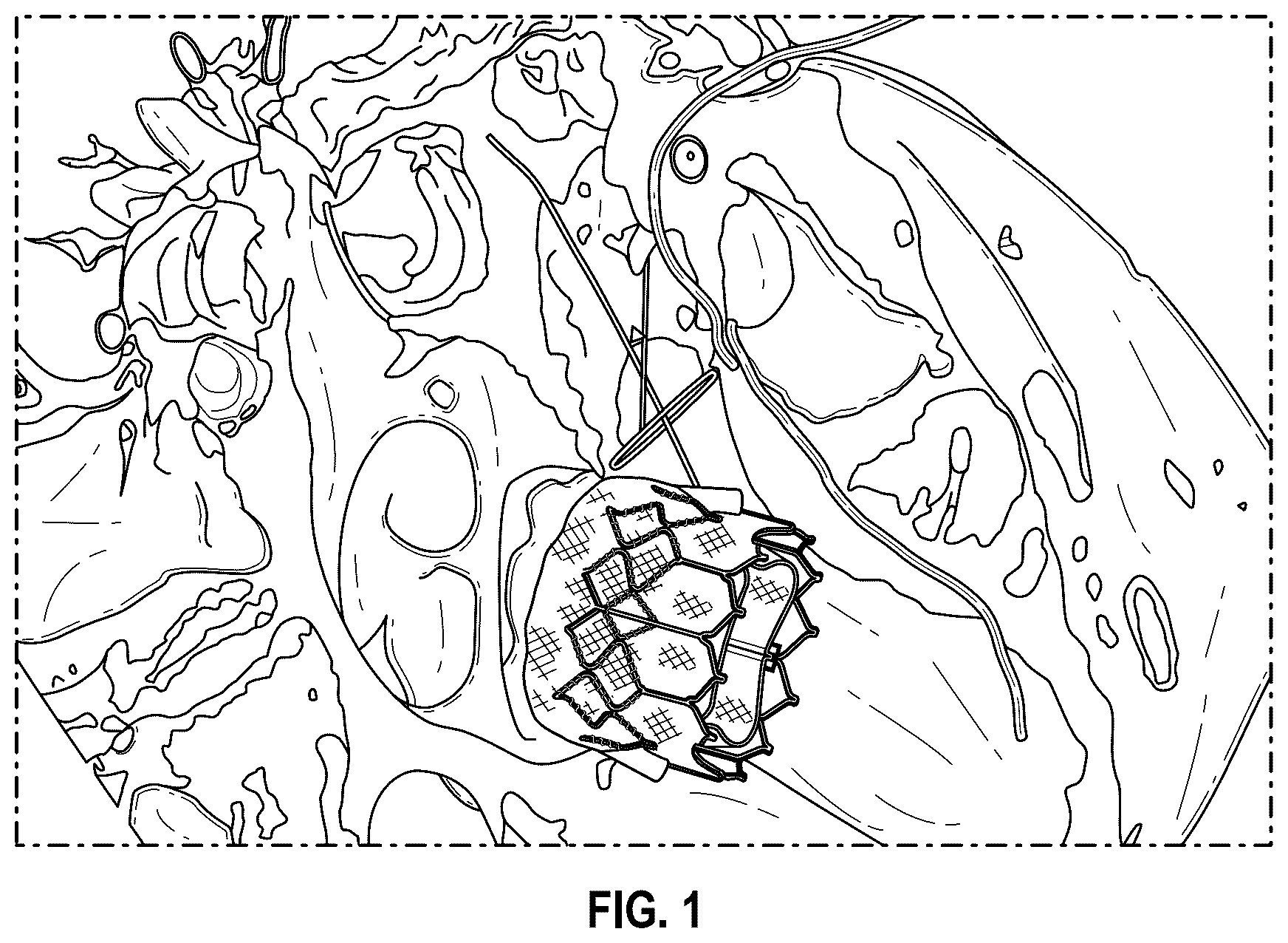 Patent US12496126 — Tissue cutting systems and methods — Figure 1