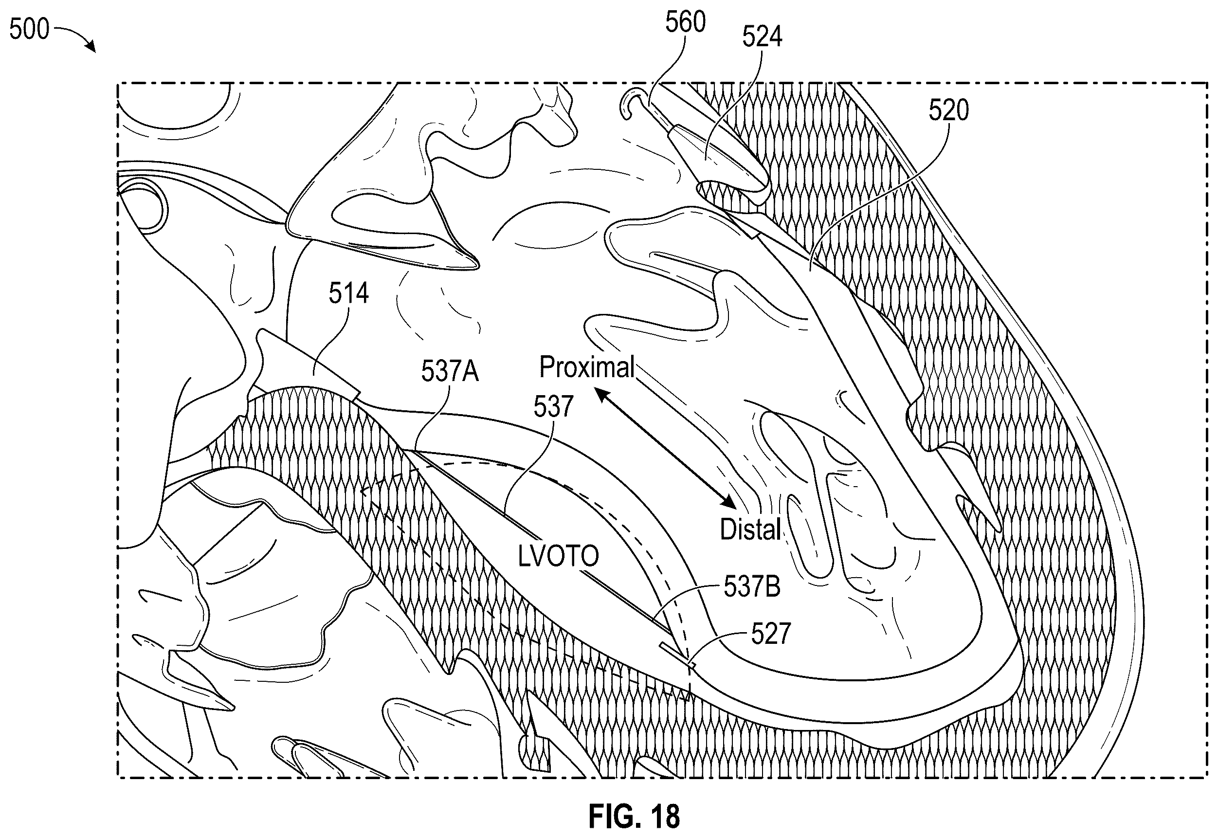 Patent US12496126 Figure 19 – Tissue cutting systems and methods