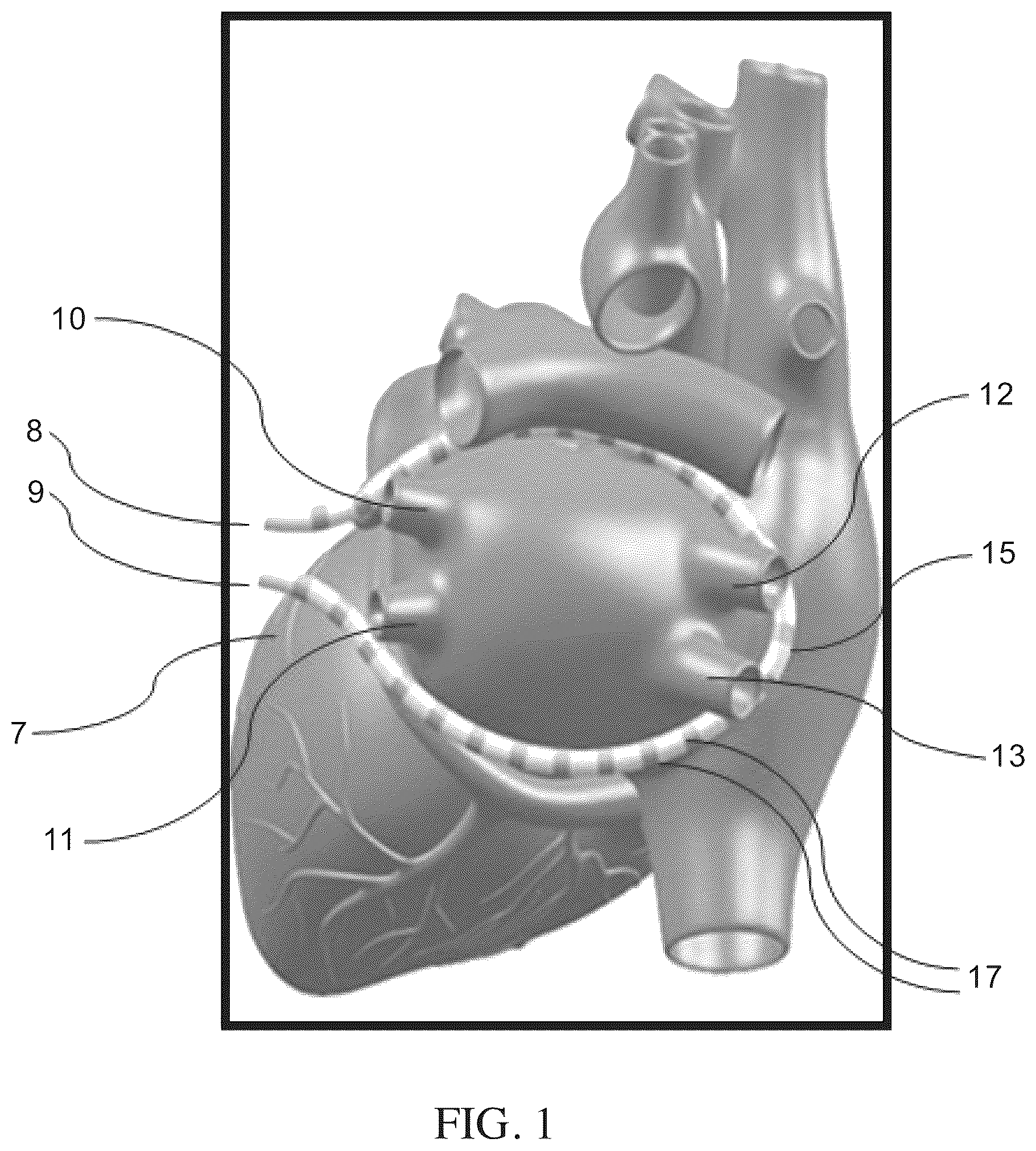 Patent US12496128 Figure 1 – Methods and apparatus for selective tissue ablation