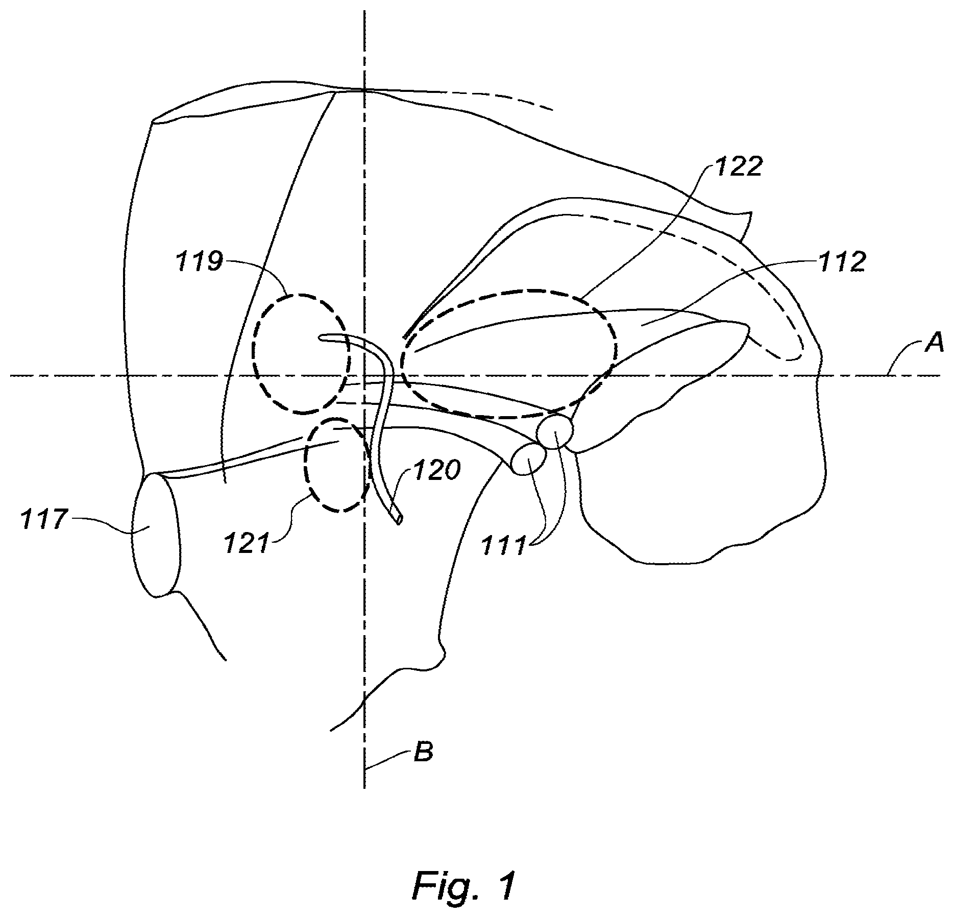 Patent US12496178 — Prosthesis for inguinal hernia repair — Figure 1