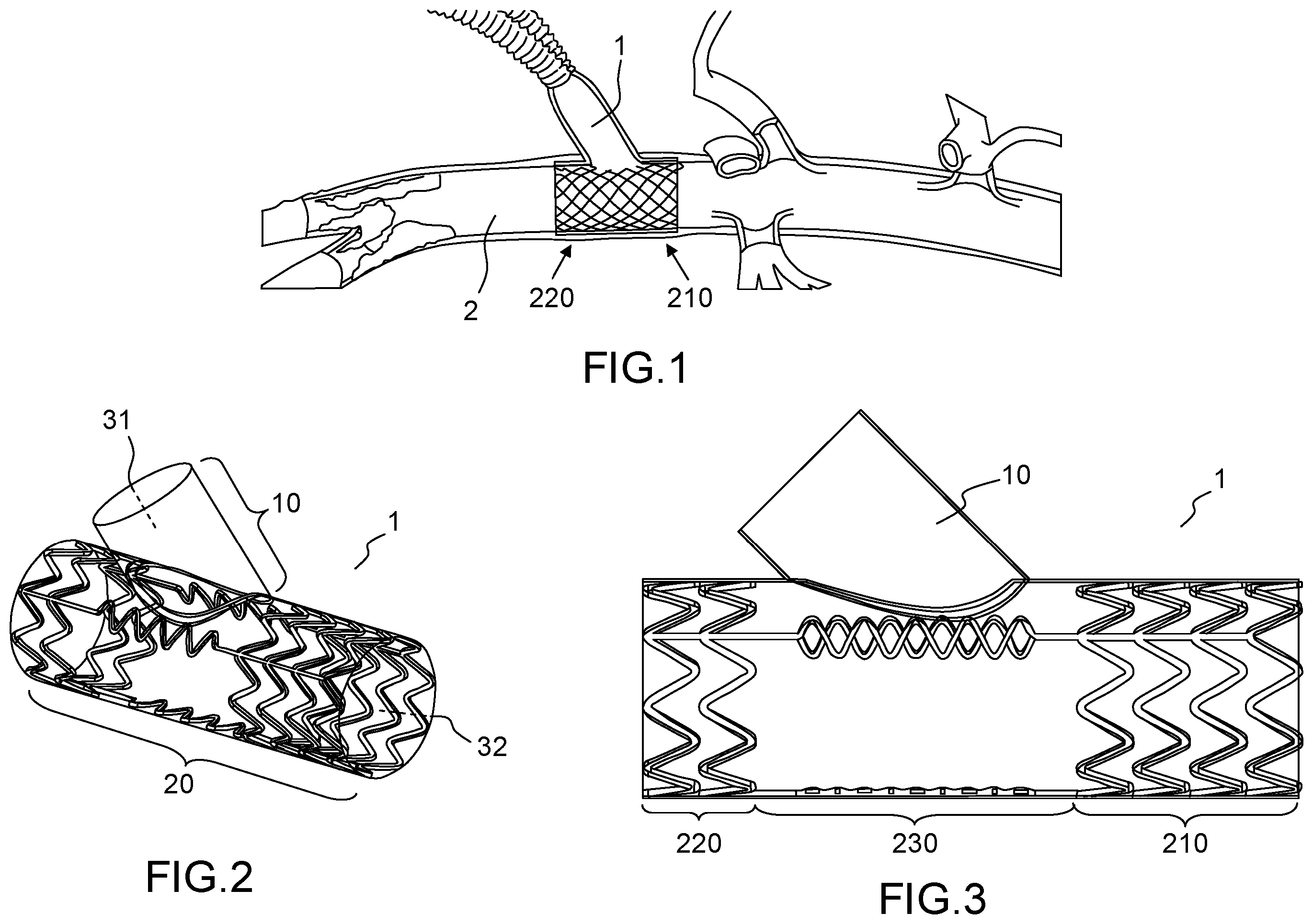 Patent US12496180 Figure 1 – Vascular prosthesis