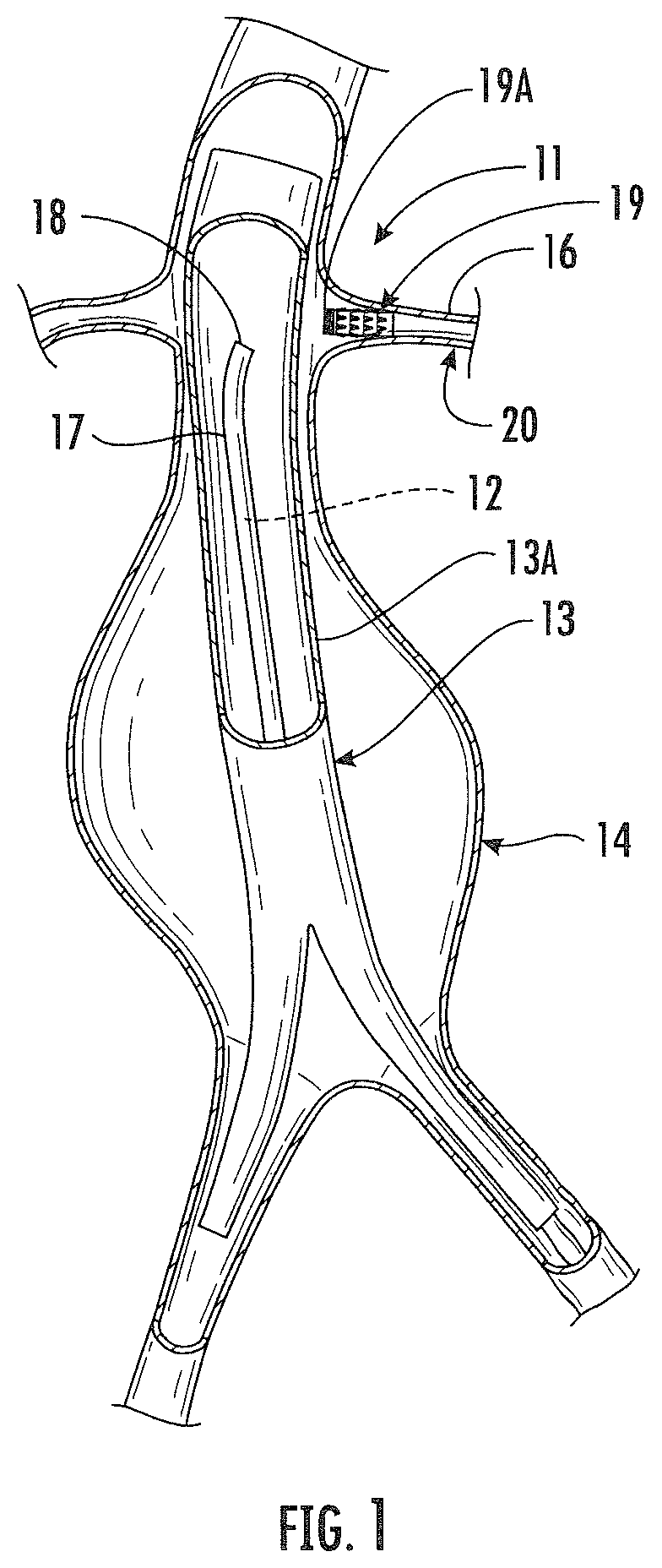 Patent US12496183 — System, method and treatment of aneurysms utilizing endographs — Figure 1