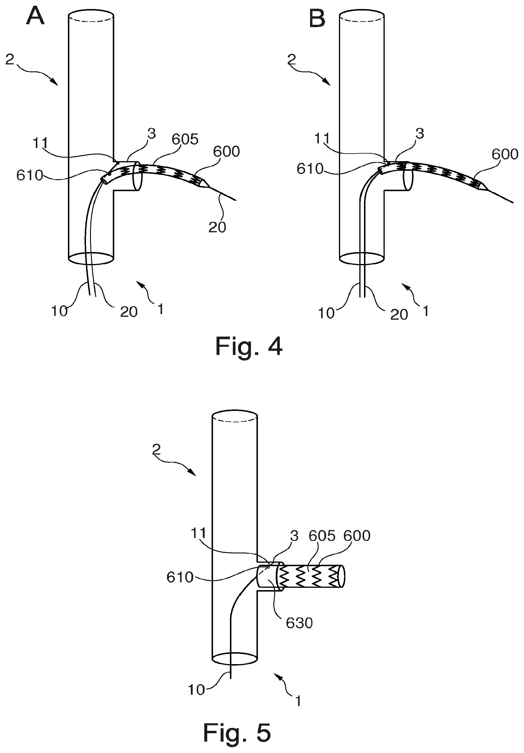 Patent US12496184 Figure 3 – Stent-graft prosthesis, system and method for improved delivery of a stent-graft prosthesis