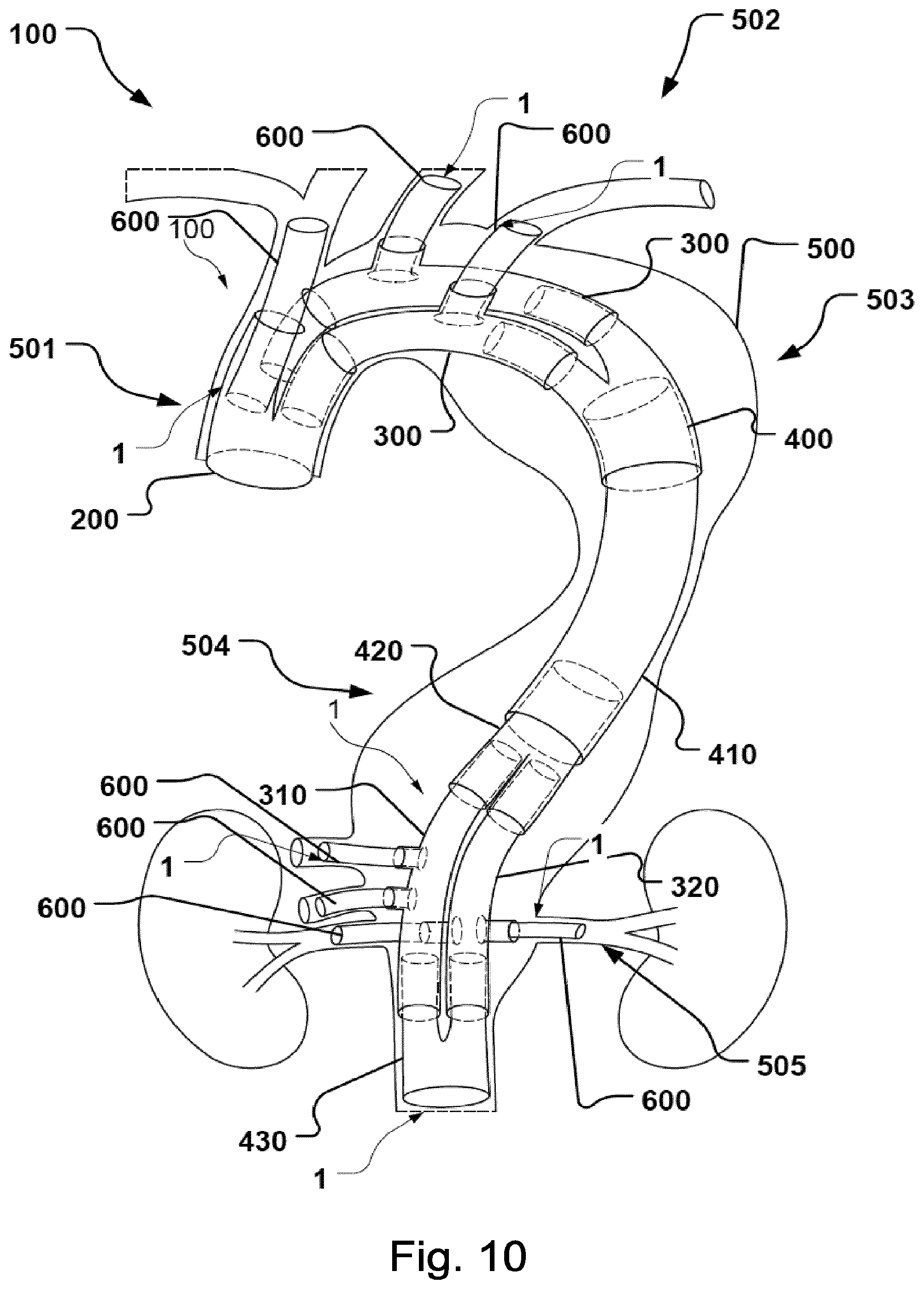 Patent US12496184 Figure 8 – Stent-graft prosthesis, system and method for improved delivery of a stent-graft prosthesis