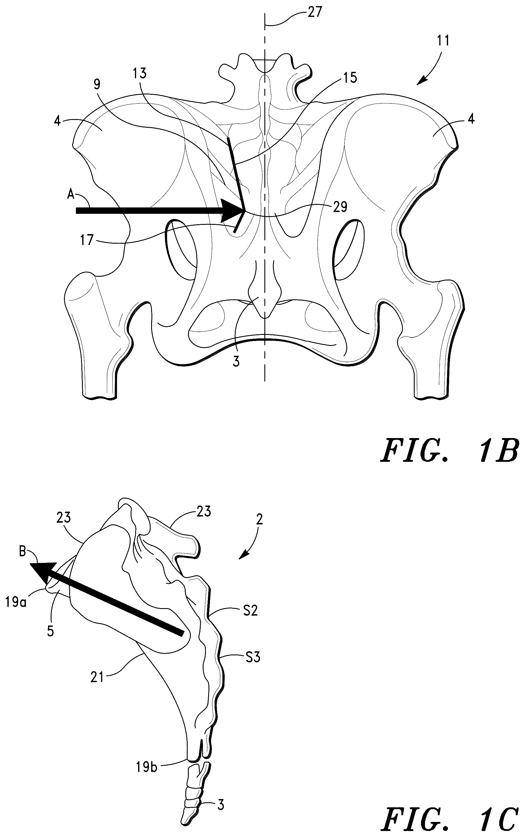Patent US12496193 Figure 2 – Methods for sacroiliac joint stabilization