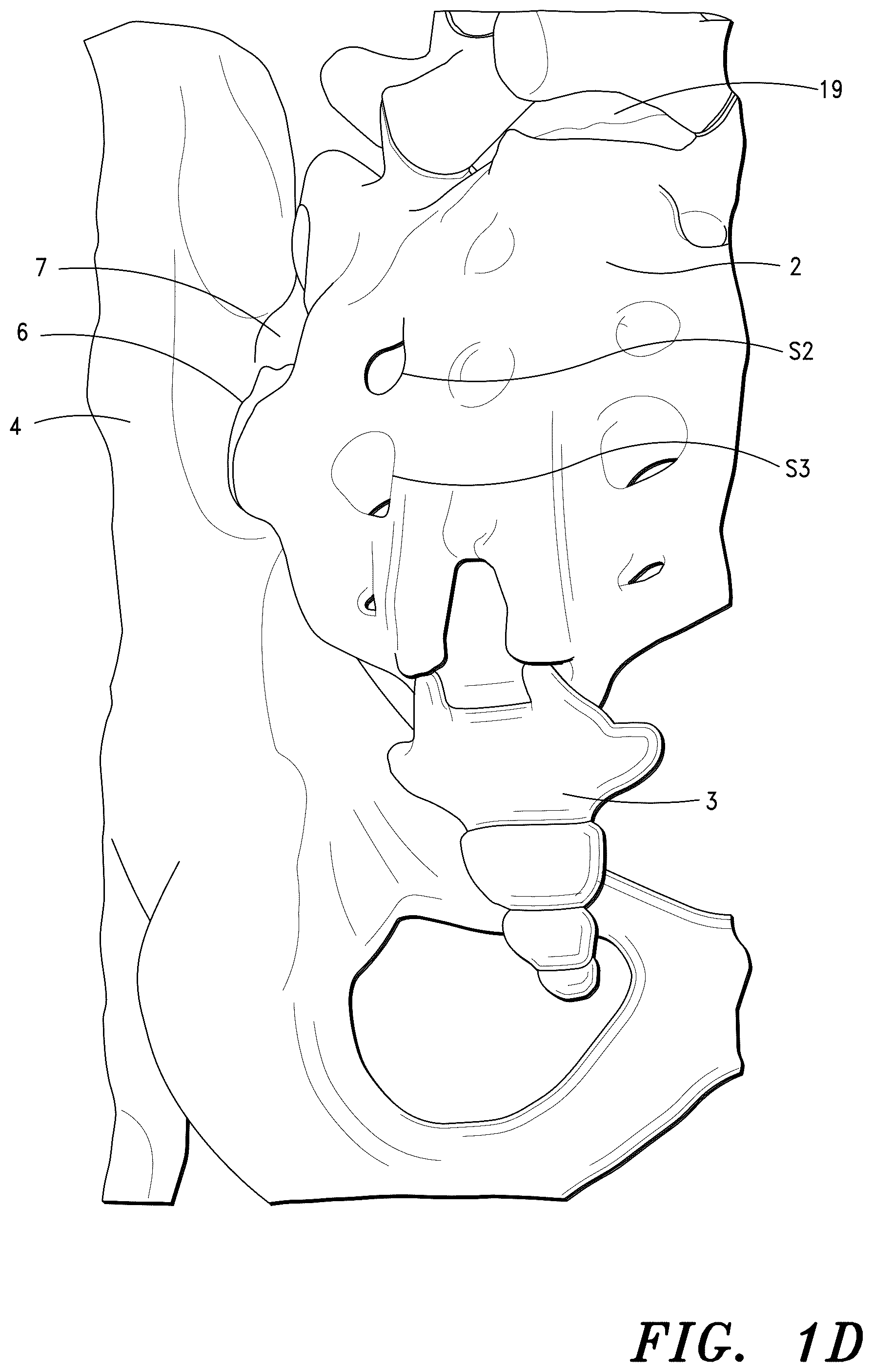 Patent US12496193 Figure 3 – Methods for sacroiliac joint stabilization
