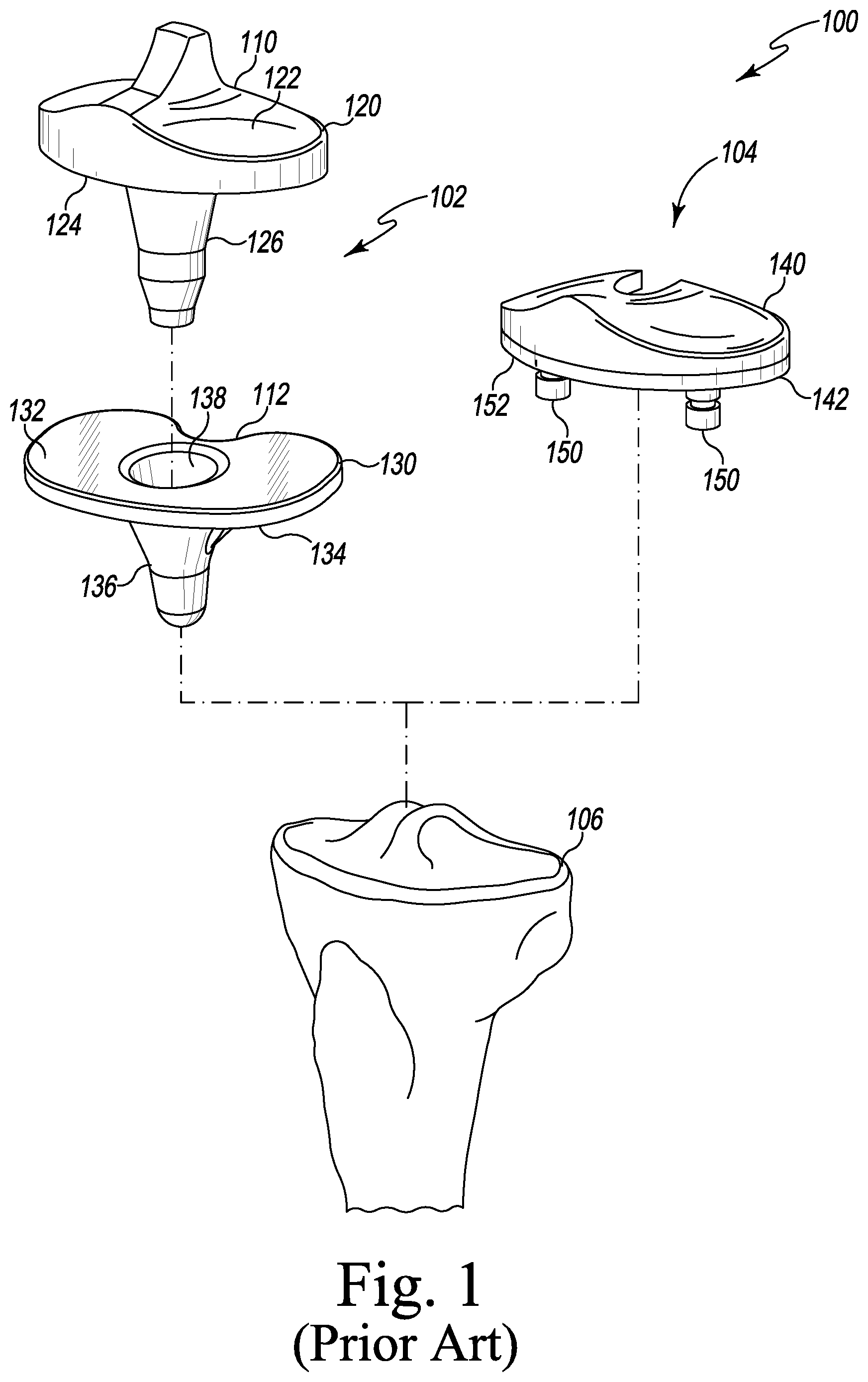 Patent US12496194 — Orthopaedic implant system with bone conserving features — Figure 1