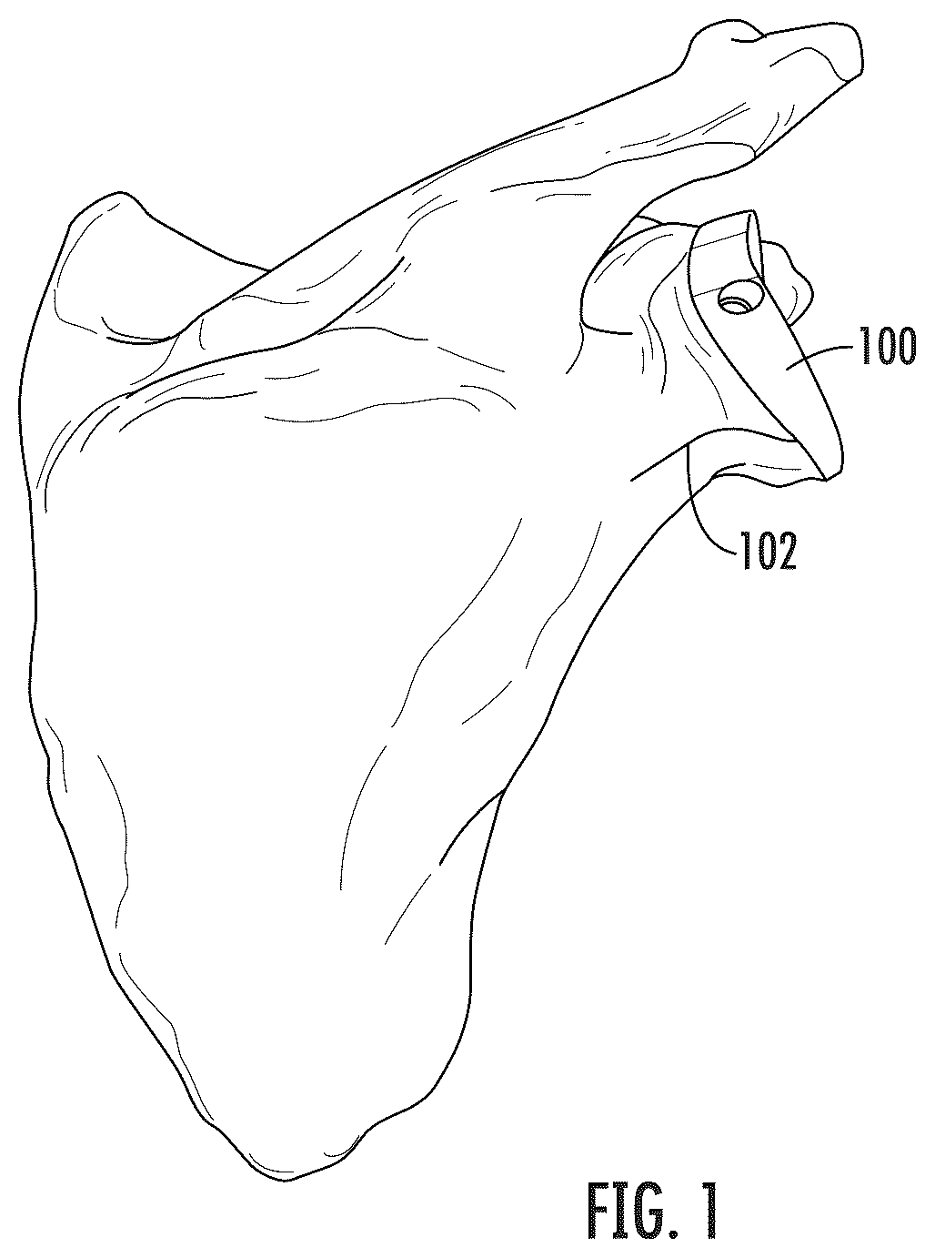Patent US12496195 Figure 1 – Systems and methods of a glenoid component